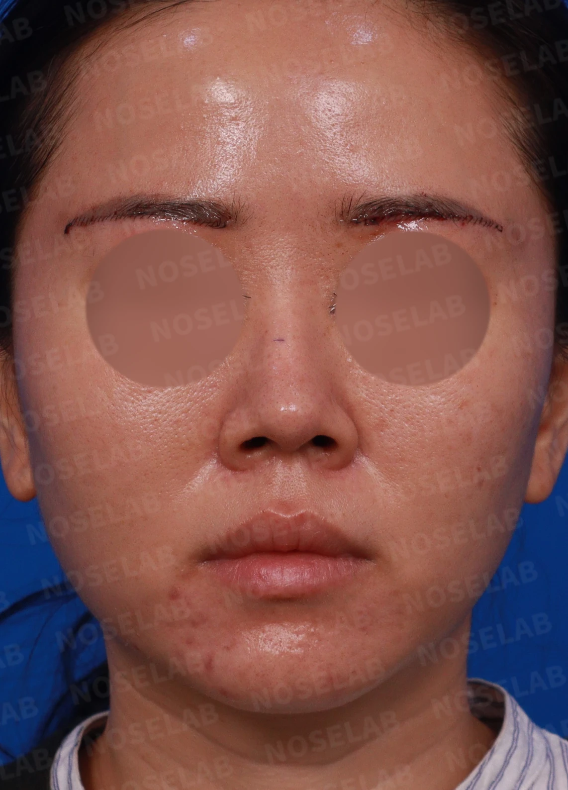 비주 내리기와 비순각 교정을 함께 계획하는 방법 — 디자인 상담 정면, 좌측 측면, 비스듬한 측면 사진입니다.