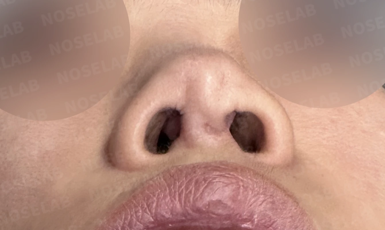 콧대에 주입한 불법 시술 이물질, 제거와 비중격 전체 재건은 어떻게 하나 — 수술 전 / 수술 직후 0일 직후 사진은 부기가 있는 상태로 최종 결과와 다를 수 있습니다.