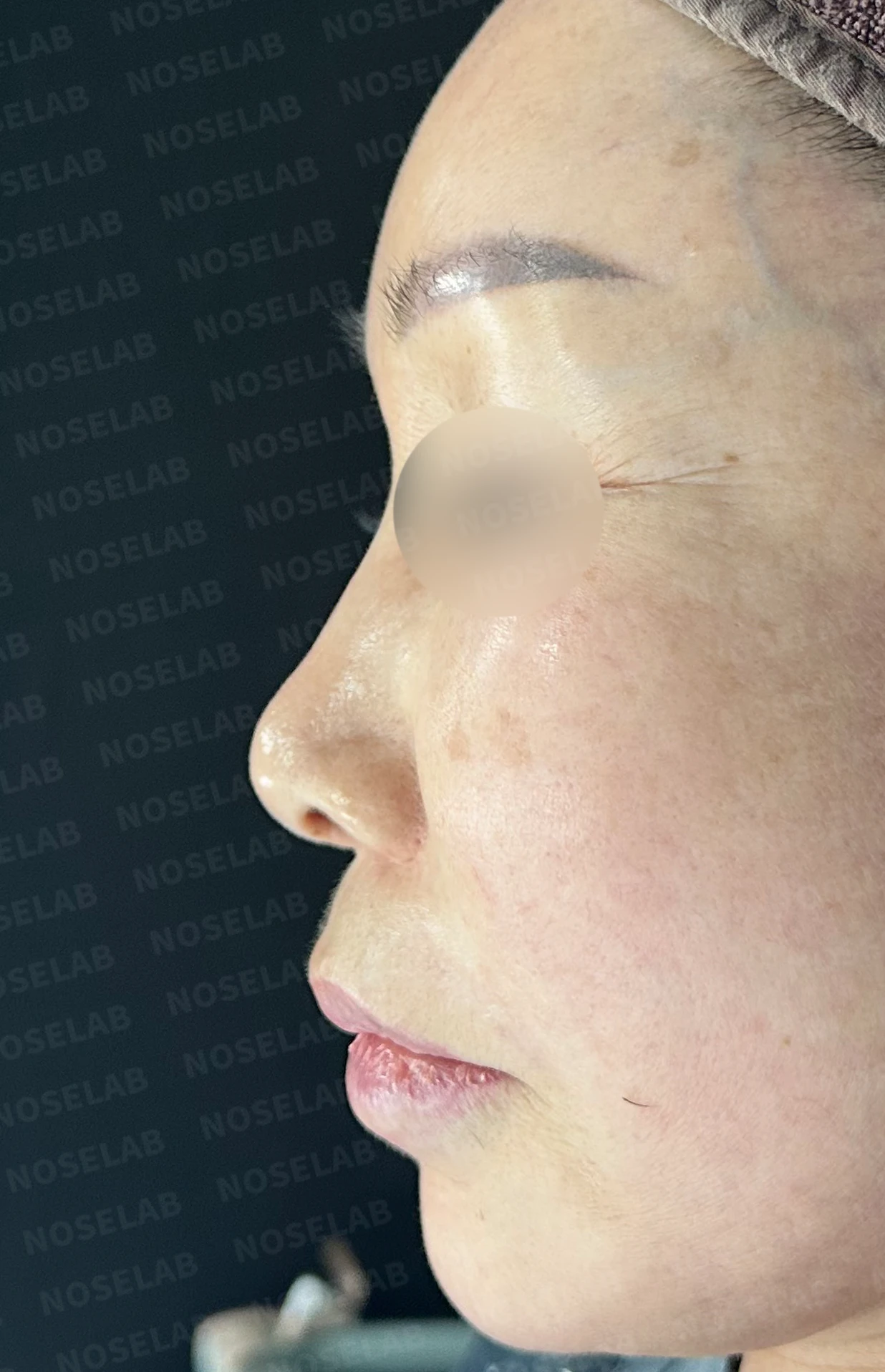 코 안에 남은 메드포어와 이물질, 왜 문제가 되고 어떻게 제거하나 — 수술 전 / 수술 직후 0일 직후 사진은 부기가 있는 상태로 최종 결과와 다를 수 있습니다.