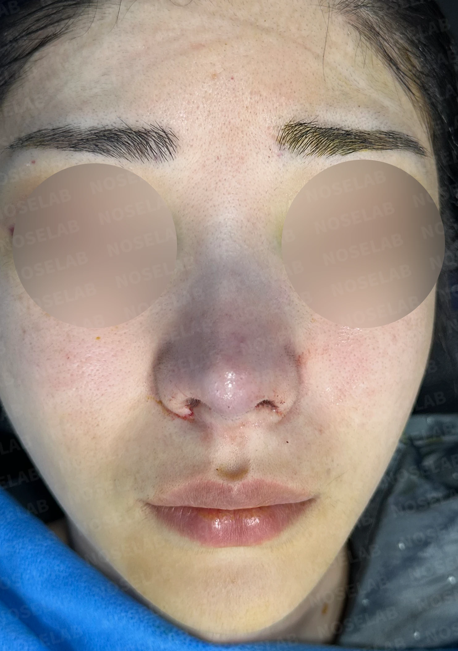 코가 뭉툭하고 퍼져 보이는 이유, 비순각과 비주는 어떻게 교정하나 — 수술 직후 0일 정면, 측면, 비스듬한 측면 사진 직후 사진은 부기가 있는 상태로 최종 결과와 다를 수 있습니다.