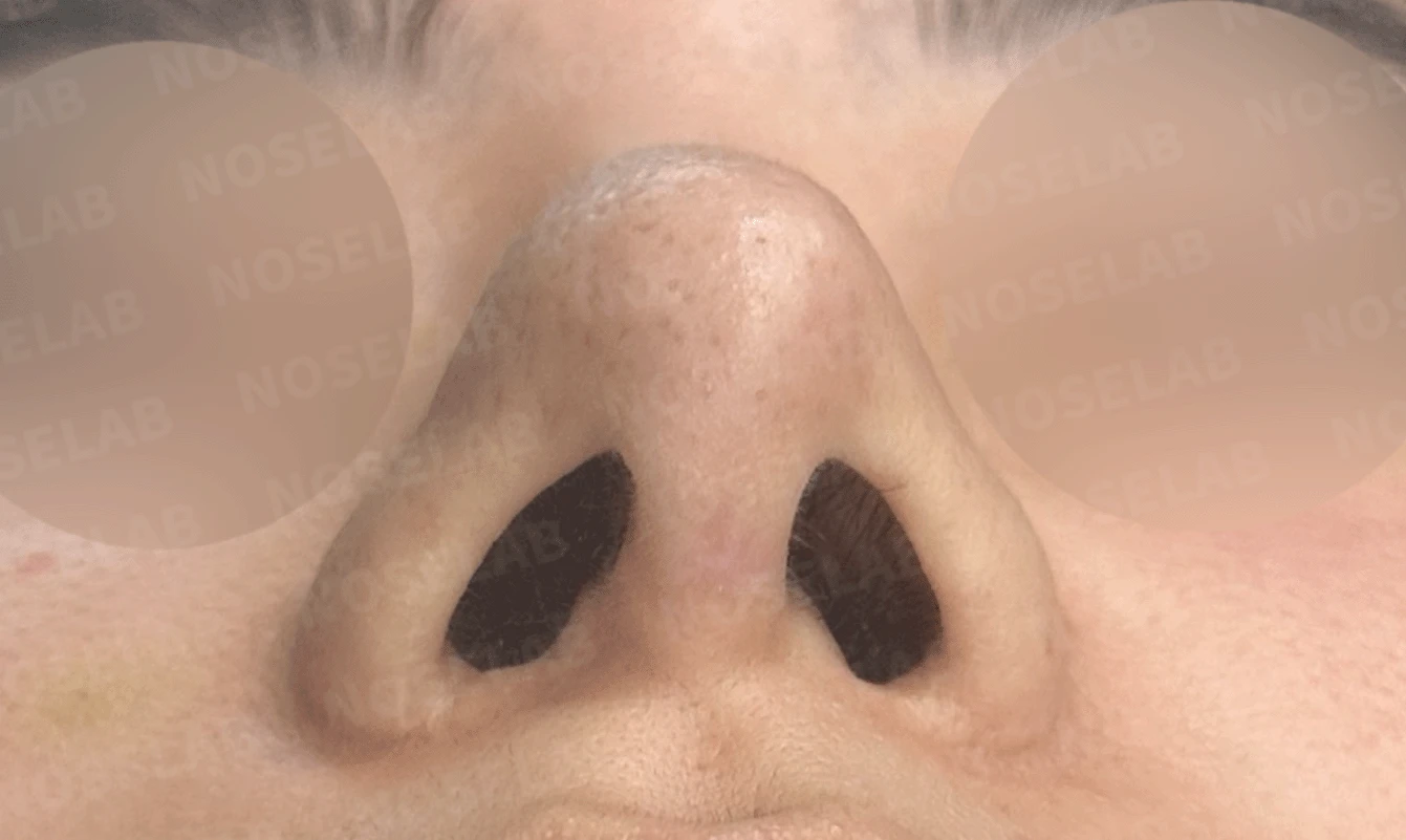 코가 과하게 높아져 부자연스러워 보이고 휘는 이유, 재건은 어떻게 하나 — 수술 전 / 수술 직후 0일 직후 사진은 부기가 있는 상태로 최종 결과와 다를 수 있습니다.