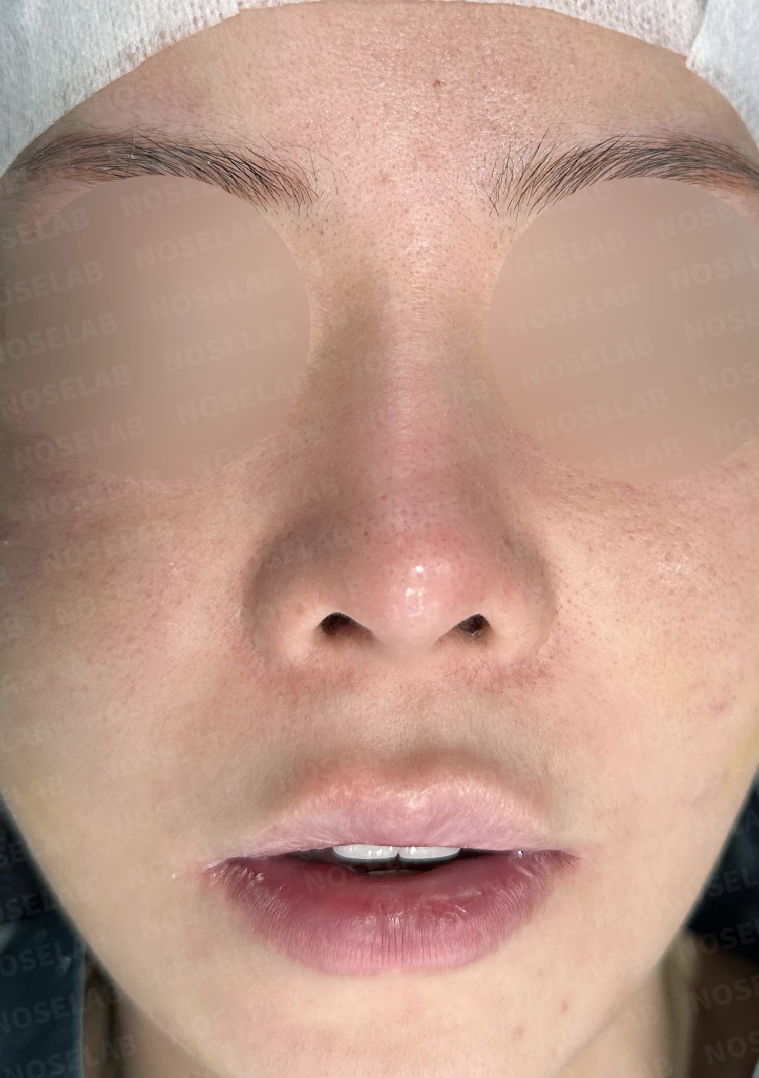 양악 수술 뒤 코가 퍼지고 낮아지는 이유와 비중격 재건 — 수술 전 / 수술 직후 0일 직후 사진은 부기가 있는 상태로 최종 결과와 다를 수 있습니다.