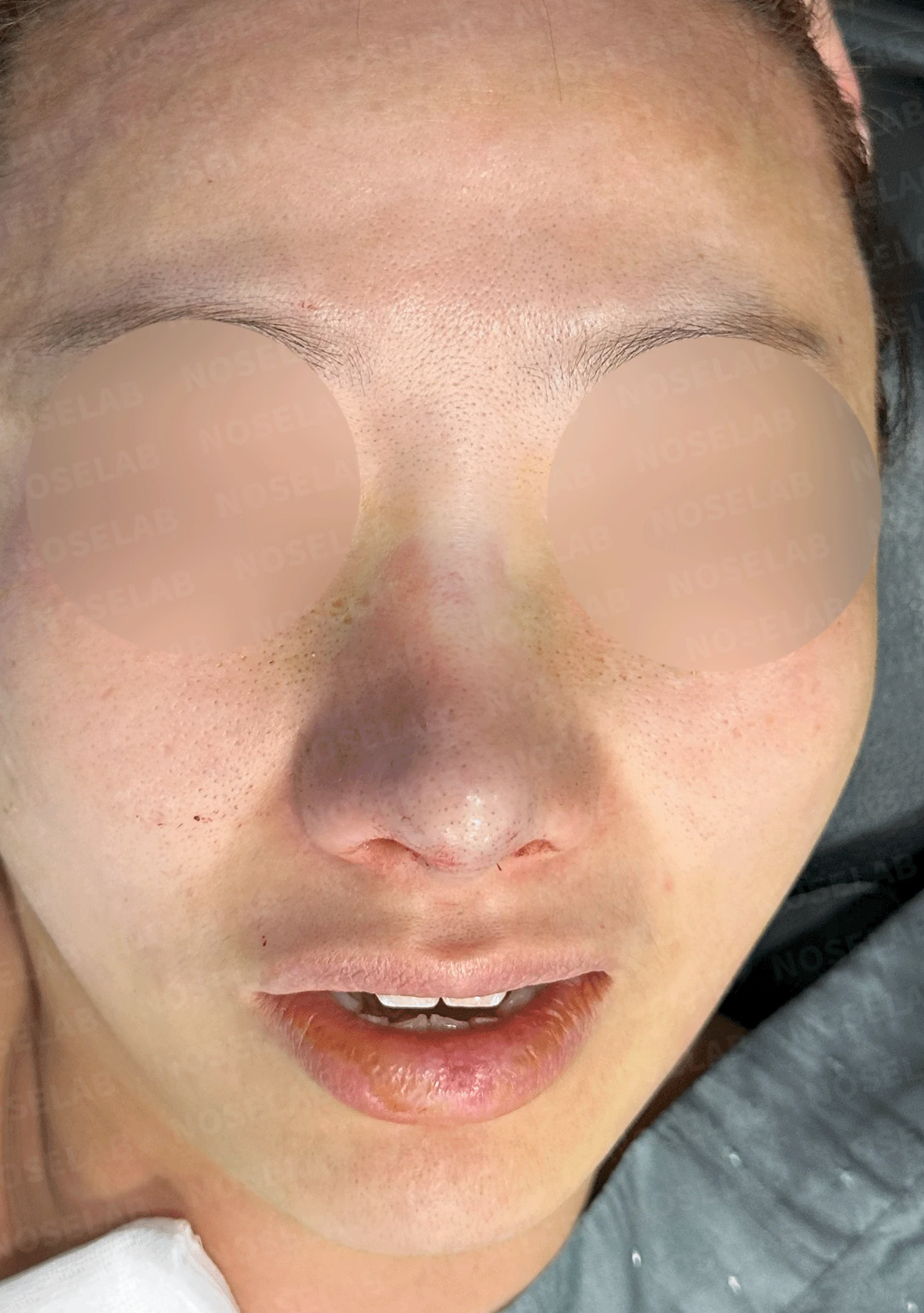 코끝 고어텍스가 문제를 일으키는 이유와 늑연골 비중격 재건 방법 — 수술 직후 0일 정면, 측면, 비스듬한 측면 사진입니다. 직후 사진은 부기가 있는 상태로 최종 결과와 다를 수 있습니다.