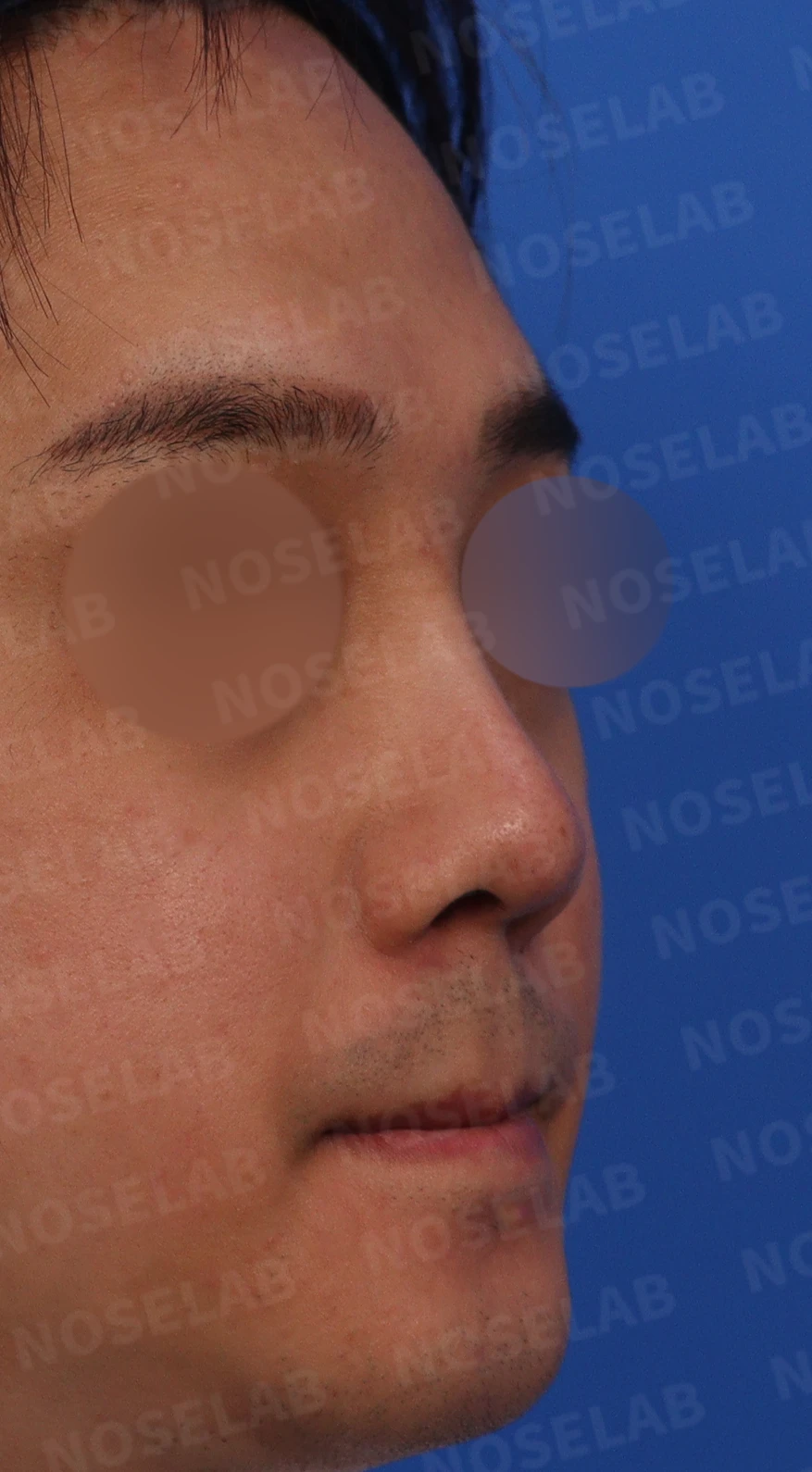 실리콘 부작용과 퍼진 코의 재수술 방법 — 수술전 디자인 상담을 위해 촬영한 정면, 비스듬한 측면, 측면 사진입니다.