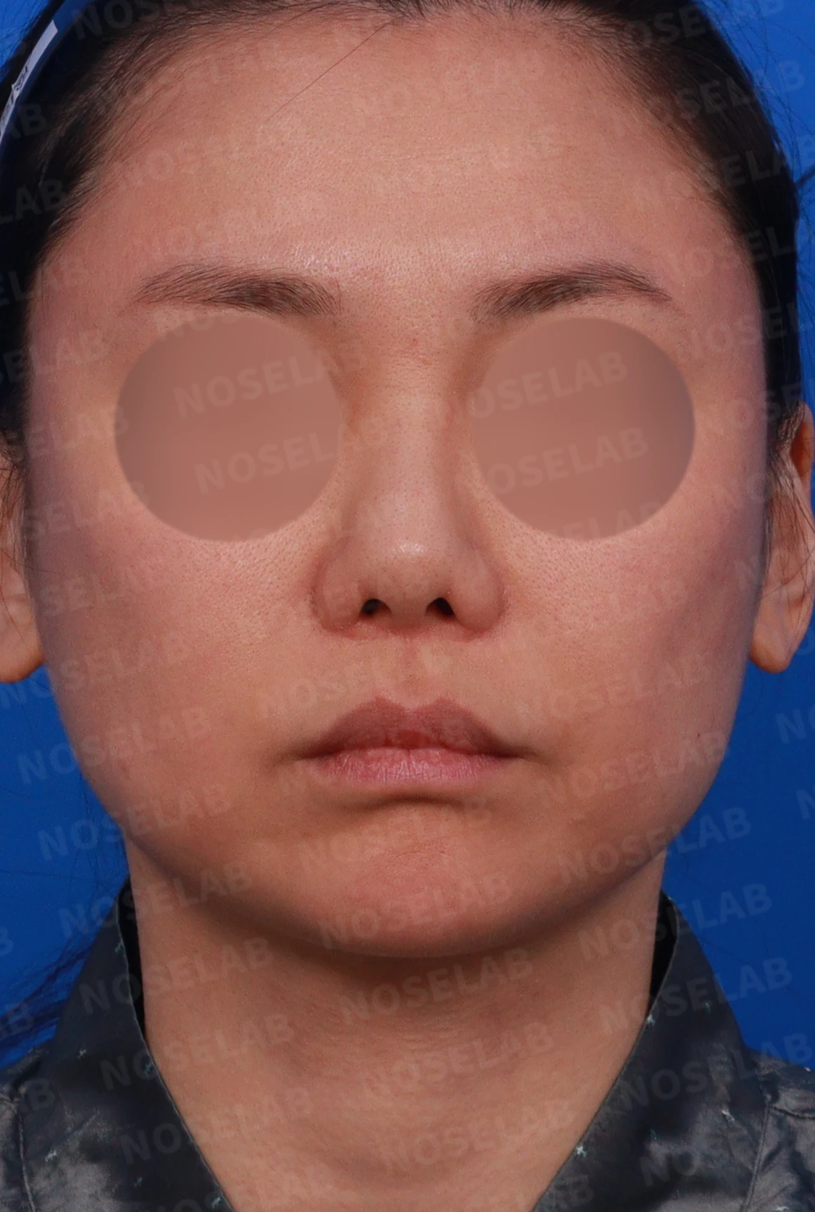 콧볼 축소 뒤 비공 비대칭과 들린 코끝이 남는 이유와 교정 방법 — 디자인 상담 정면, 좌측 측면, 비스듬한 측면 사진