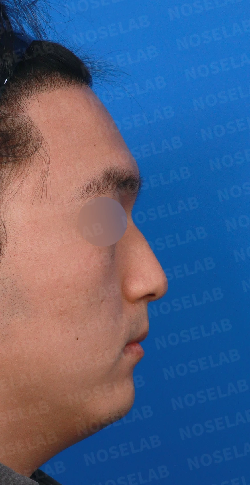 비중격이 휘면 코막힘과 휜 코가 함께 생기는 이유, 재건은 어떻게 하나 — 디자인 상담 우측 측면, 비스듬한 측면, 비공 사진입니다.