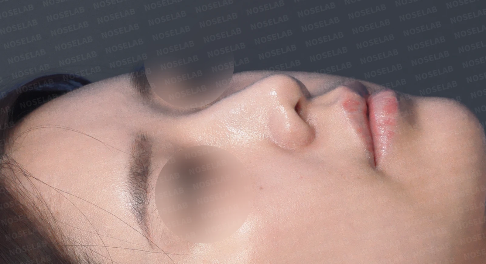 돌출입과 비순각을 함께 살펴보는 코성형 계획 — 수술 전 / 수술 직후 0일 직후 사진은 부기가 있는 상태로 최종 결과와 다를 수 있습니다.