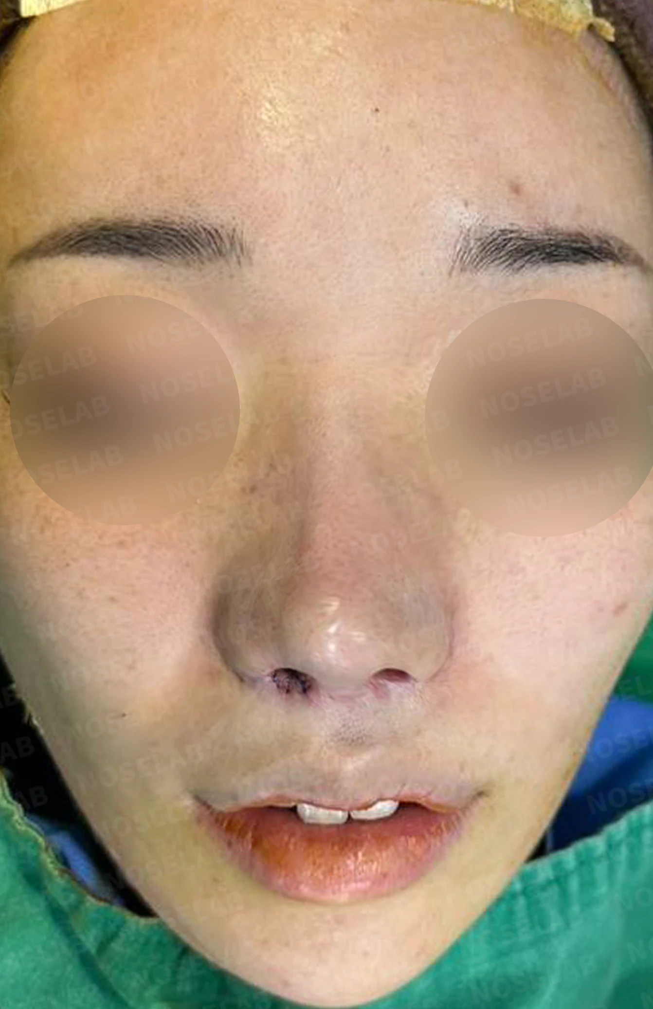 콧구멍 비대칭과 협착이 생기는 이유, 늑연골 재건과 Z성형은 어떻게 하나 — 수술 직후 0일 정면, 비스듬한 측면, 측면 사진입니다. 직후 사진은 부기가 있는 상태로 최종 결과와 다를 수 있습니다.