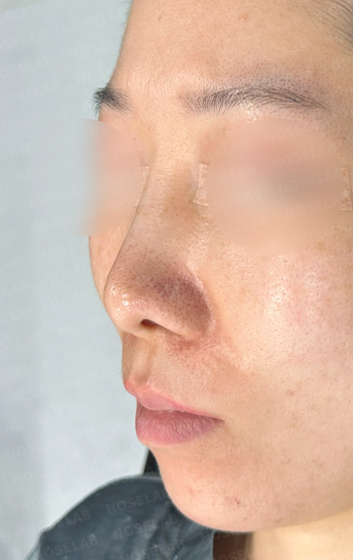 콧대 시작점이 높고 코가 휘어 보이는 이유, 자가 늑연골 교정은 어떻게 하나 — 수술 전 / 수술 직후 0일 직후 사진은 부기가 있는 상태로 최종 결과와 다를 수 있습니다.