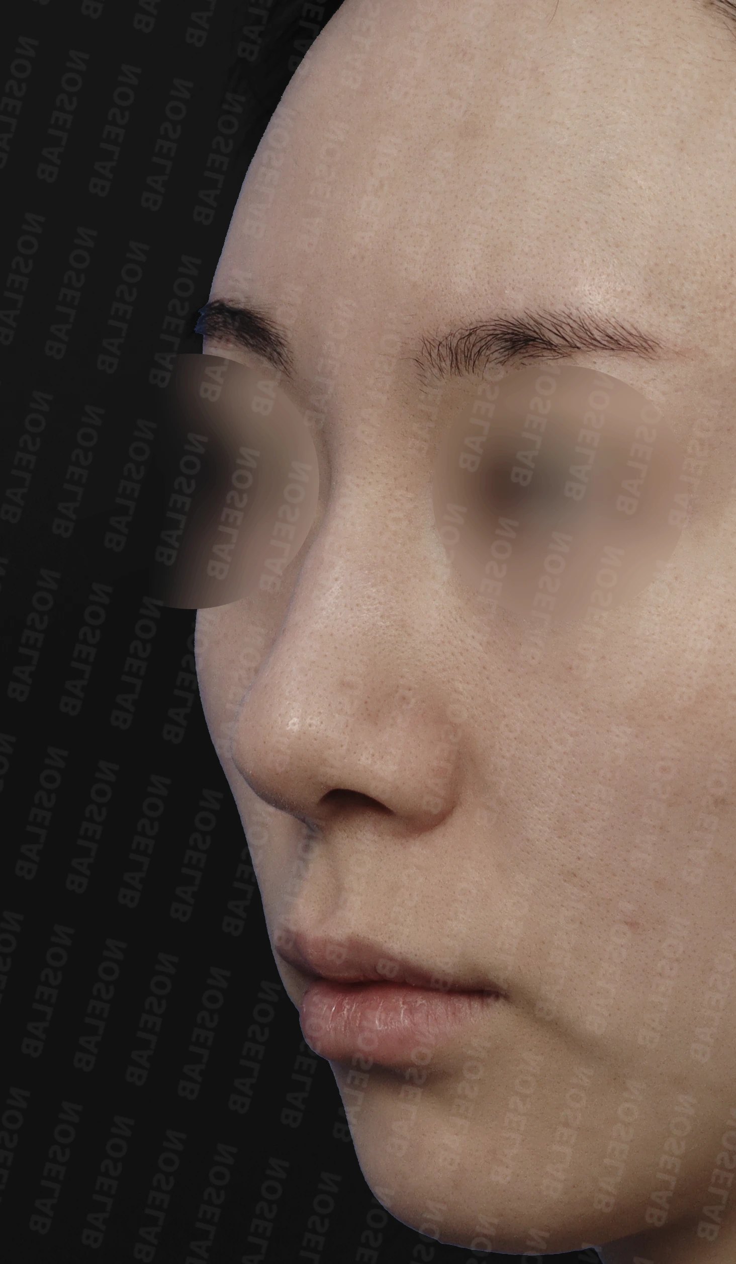 뭉툭한 복코의 구조와 교정 방법 — 본문 사진 3