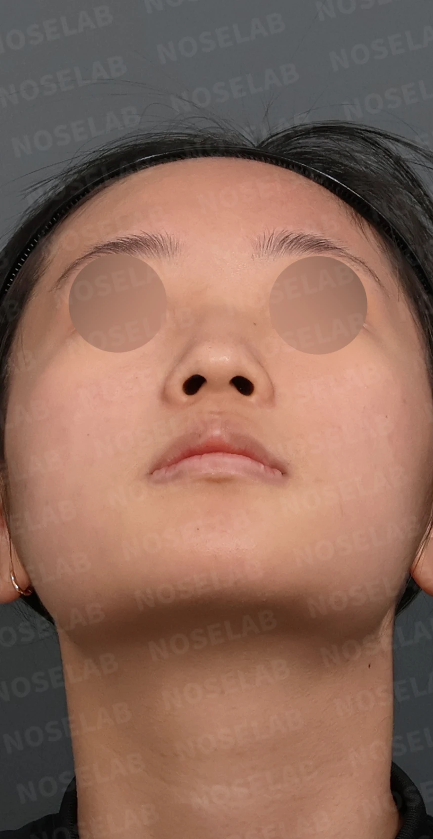 작은 콧날개 연골과 처진 코끝, 자가늑연골과 외측절골술로 자연스럽게 교정 — 디자인 상담 우측 측면, 비스듬한 측면, 비공 사진입니다.