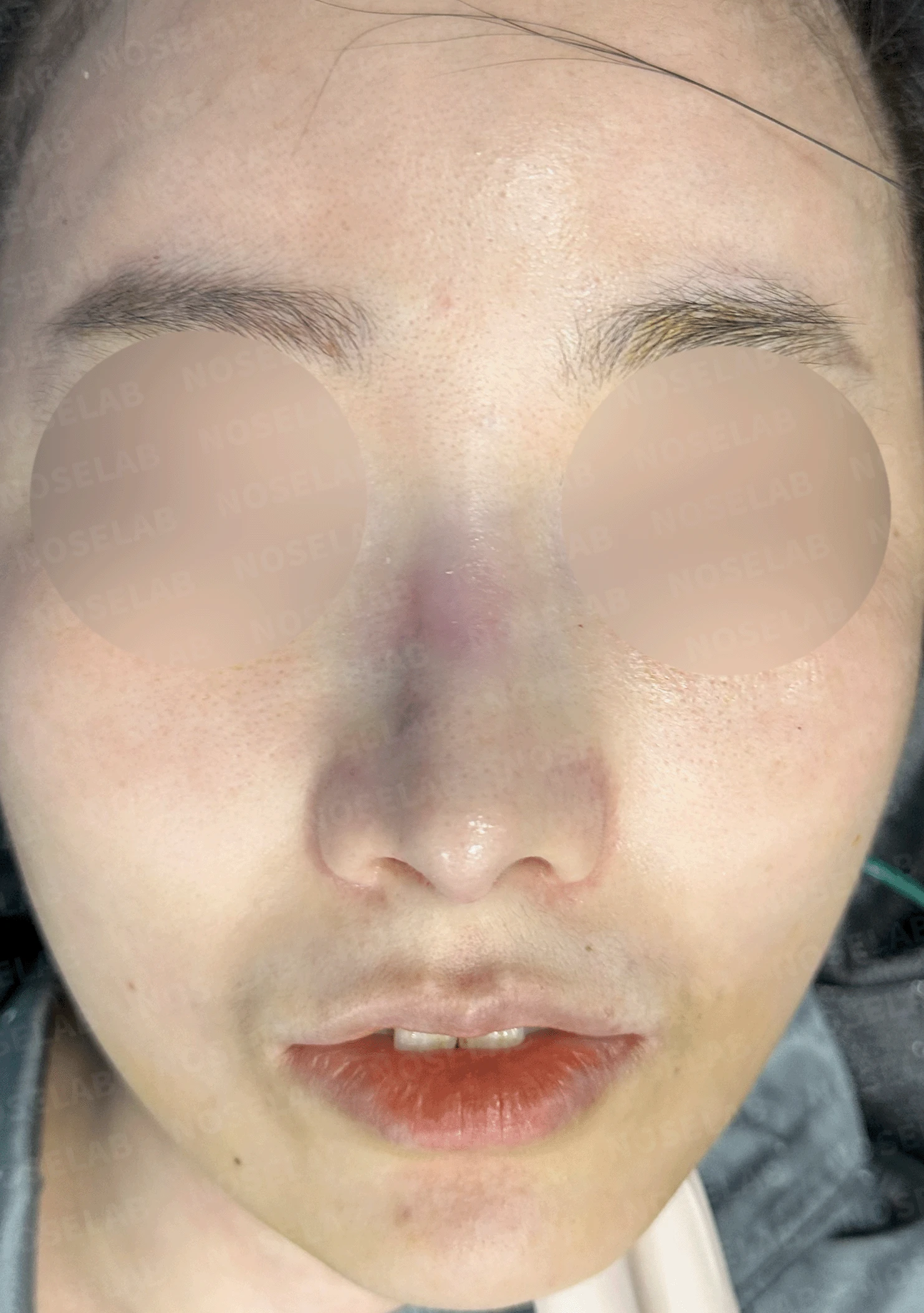 낮은 코의 지지 구조와 자가늑연골 교정 방법 — 수술 직후 0일 정면, 비스듬한 측면, 측면 사진입니다. 직후 사진은 부기가 있는 상태로 최종 결과와 다를 수 있습니다.