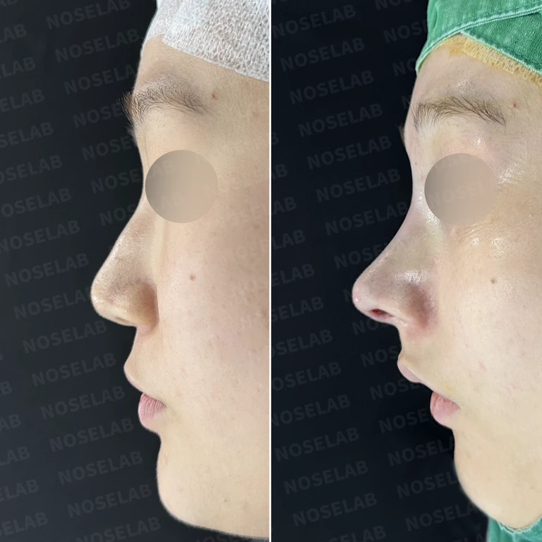퍼진 코끝과 비염, 자가늑연골로 미용과 기능 동시 개선 — 전후 비교