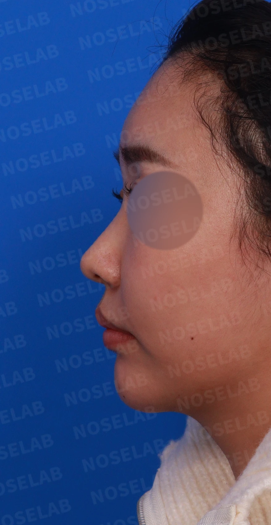 비염 수술을 받았는데도 코막힘이 돌아오는 이유, 구조 교정은 어떻게 하나 — 디자인 상담 정면, 좌측 측면, 비스듬한 측면 사진