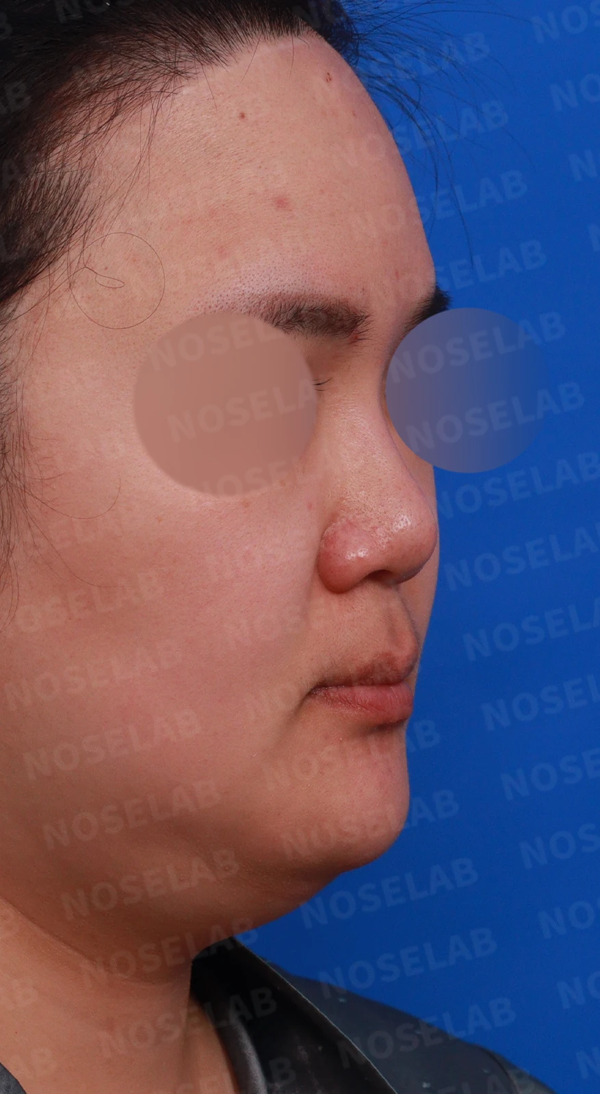 코에 삽입된 매선을 제거하고 재건하는 방법 — 디자인 상담 우측 측면, 비스듬한 측면, 비공 사진입니다.