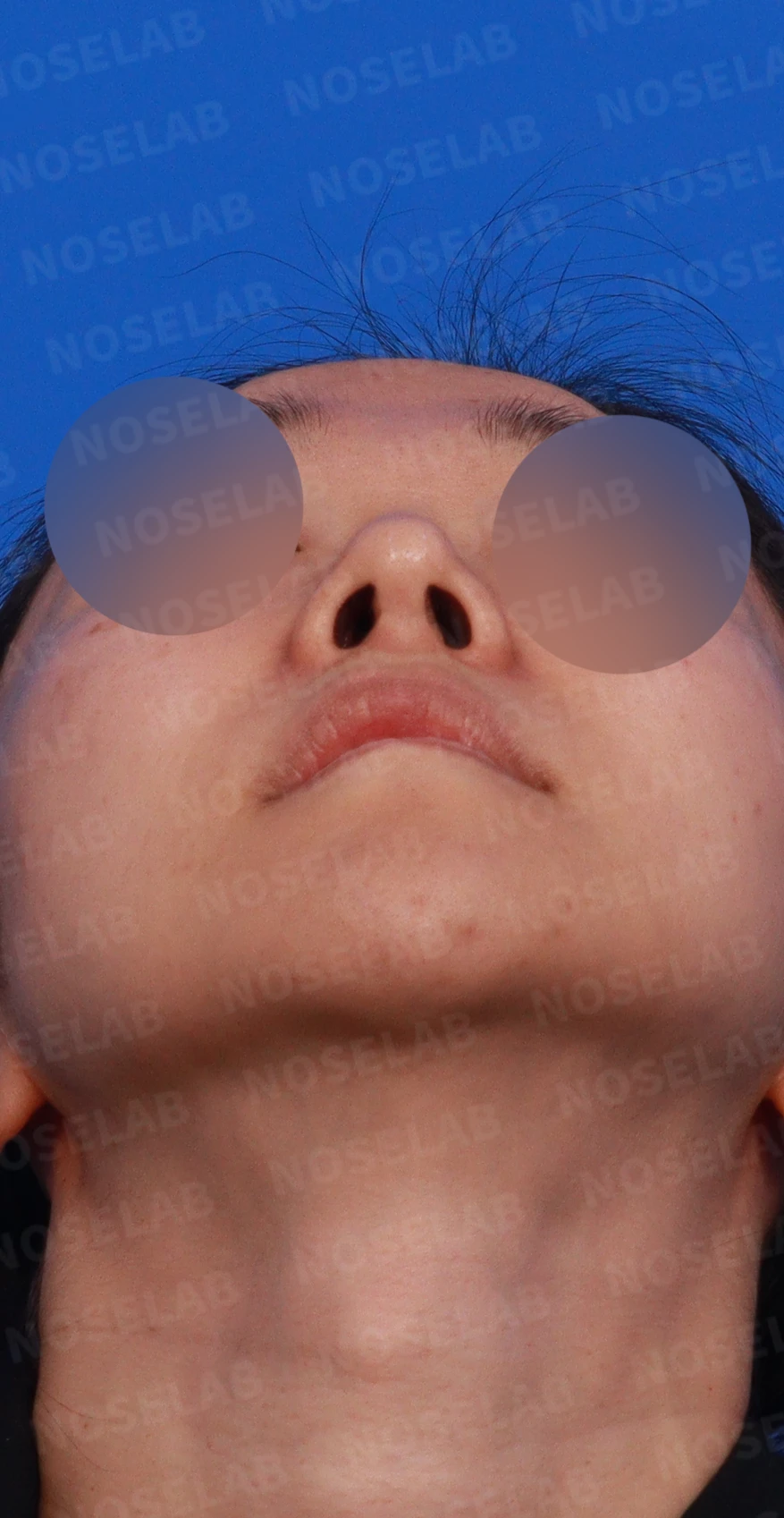 비중격 연골이 약해진 코, 보형물 없이 재건하는 방법 — 디자인 상담 우측 비스듬한 측면, 측면, 비공 사진