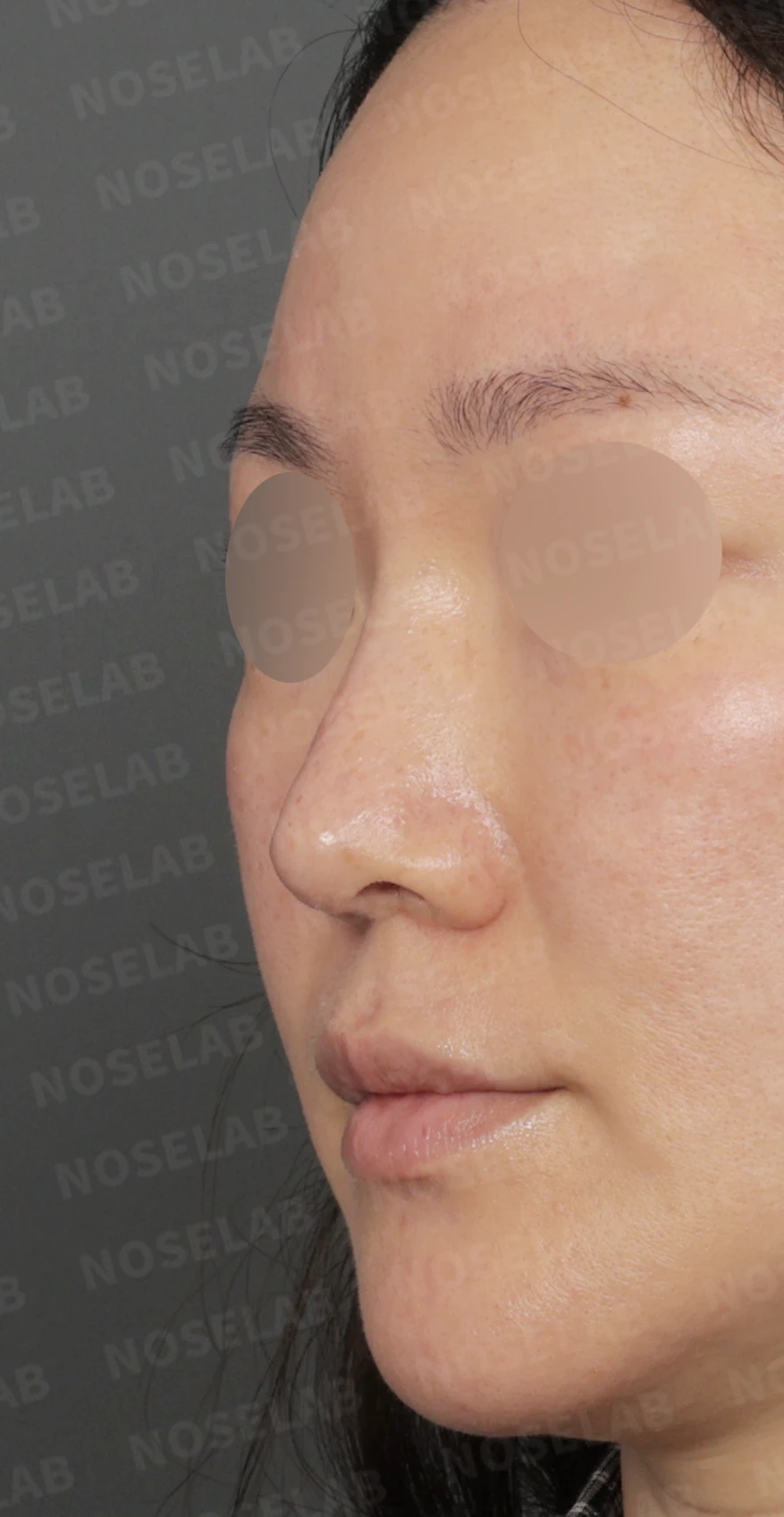 길고 처진 코 교정, 자가늑연골 비중격 재건과 콧대 보형물 교체로 완성한 코재수술 — 디자인 상담 정면 , 좌측 측면 , 비스듬한 측면 사진 입니다.
