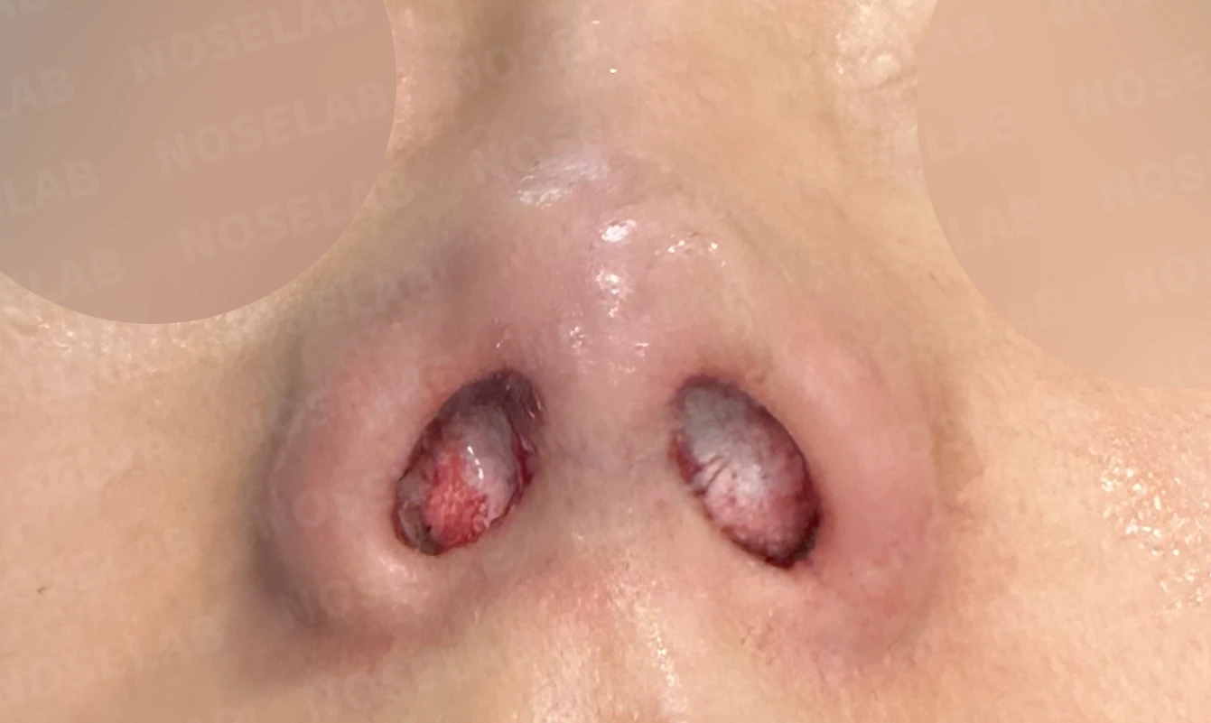 기증 늑연골이 흡수되면 코가 어떻게 변하고, 자가 늑연골 재건은 어떻게 하나 — 수술 전 / 수술 직후 0일 직후 사진은 부기가 있는 상태로 최종 결과와 다를 수 있습니다.