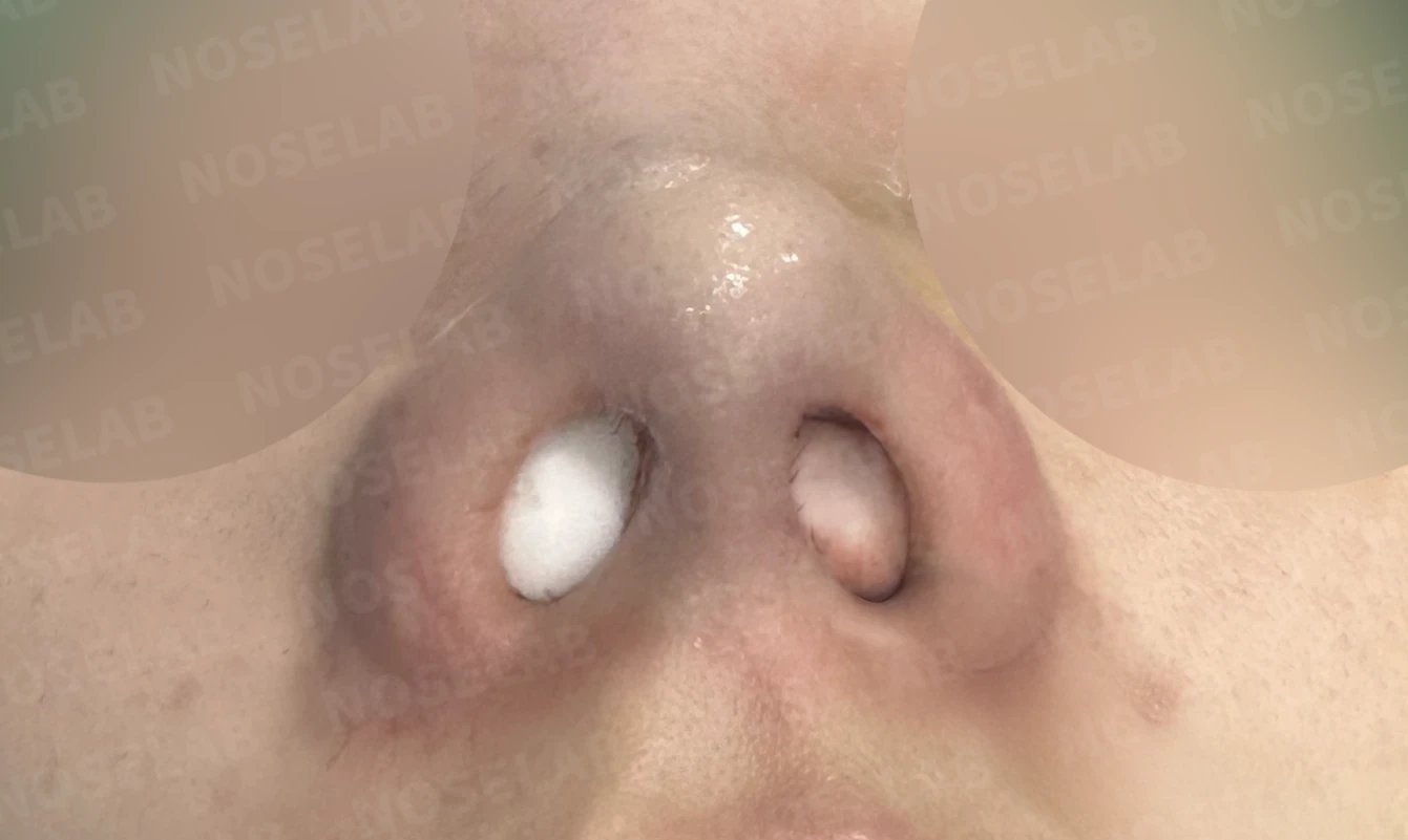 복코가 뭉툭하고 퍼져 보이는 이유와 코끝 입체감을 만드는 방법 — 수술 직후 0일 비공 사진입니다 직후 사진은 부기가 있는 상태로 최종 결과와 다를 수 있습니다.