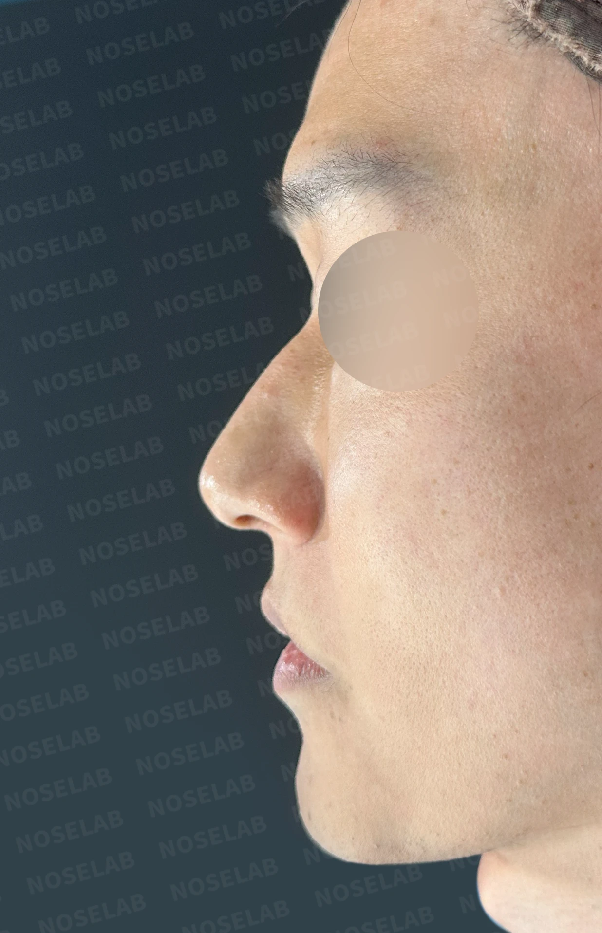 안면 비대칭이 있는 코에 맞춤형 보형물을 쓰는 이유와 매부리 교정 방법 — 본문 사진 10