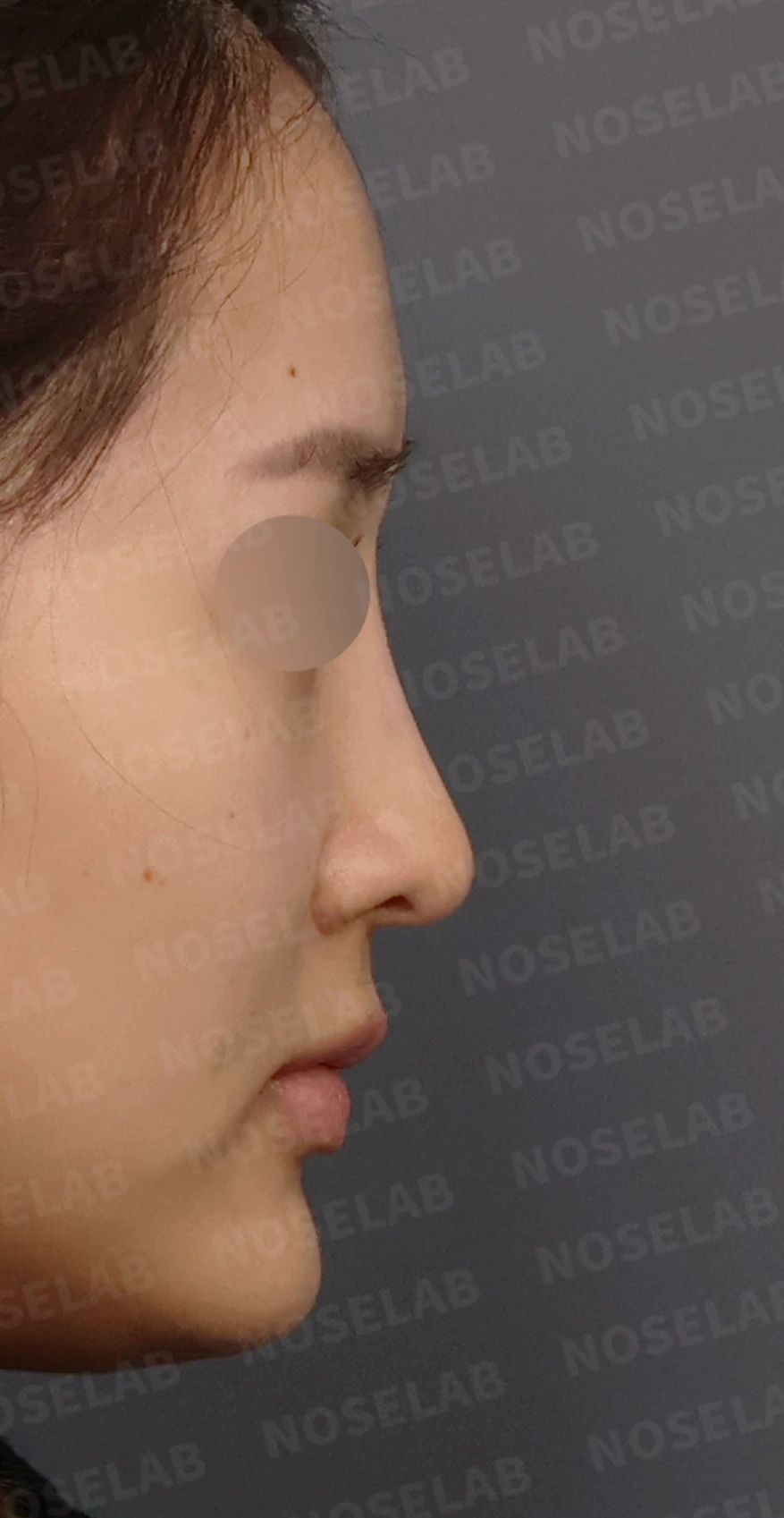 코성형 뒤 코끝이 처져 코가 길어 보이는 이유, 자가늑연골 코끝 재건 방법 — 디자인 상담 우측 측면, 비스듬한 측면, 비공 사진입니다.