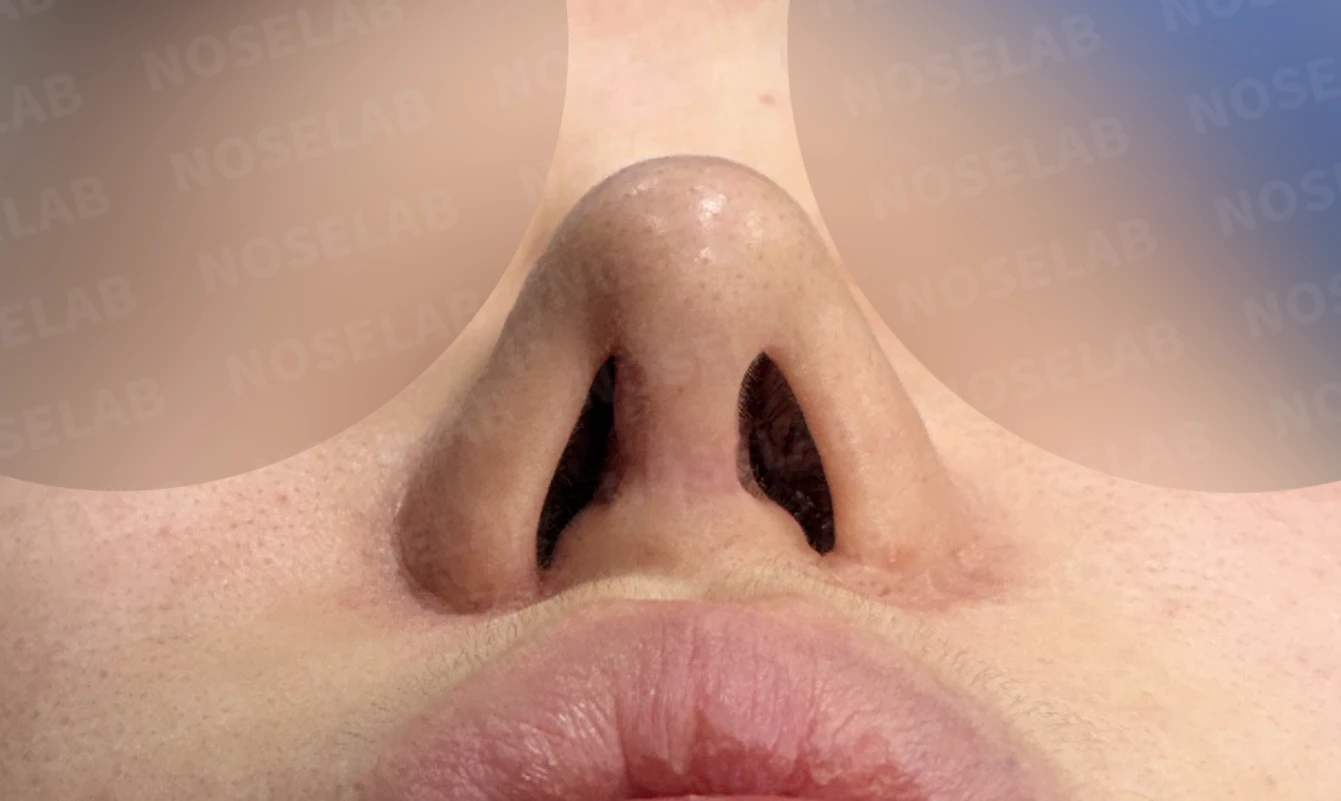 긴 코와 비공 비대칭, 자가늑연골로 자연스럽게 교정한 코재수술 — 전(좌) 직후(우)