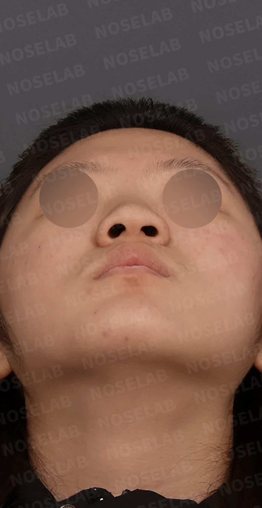 뭉툭한 코끝과 퍼진 코, 자가늑연골 비중격 연장술로 자연스럽게 교정 — 디자인 상담 우측 측면, 비스듬한 측면, 비공 사진입니다.