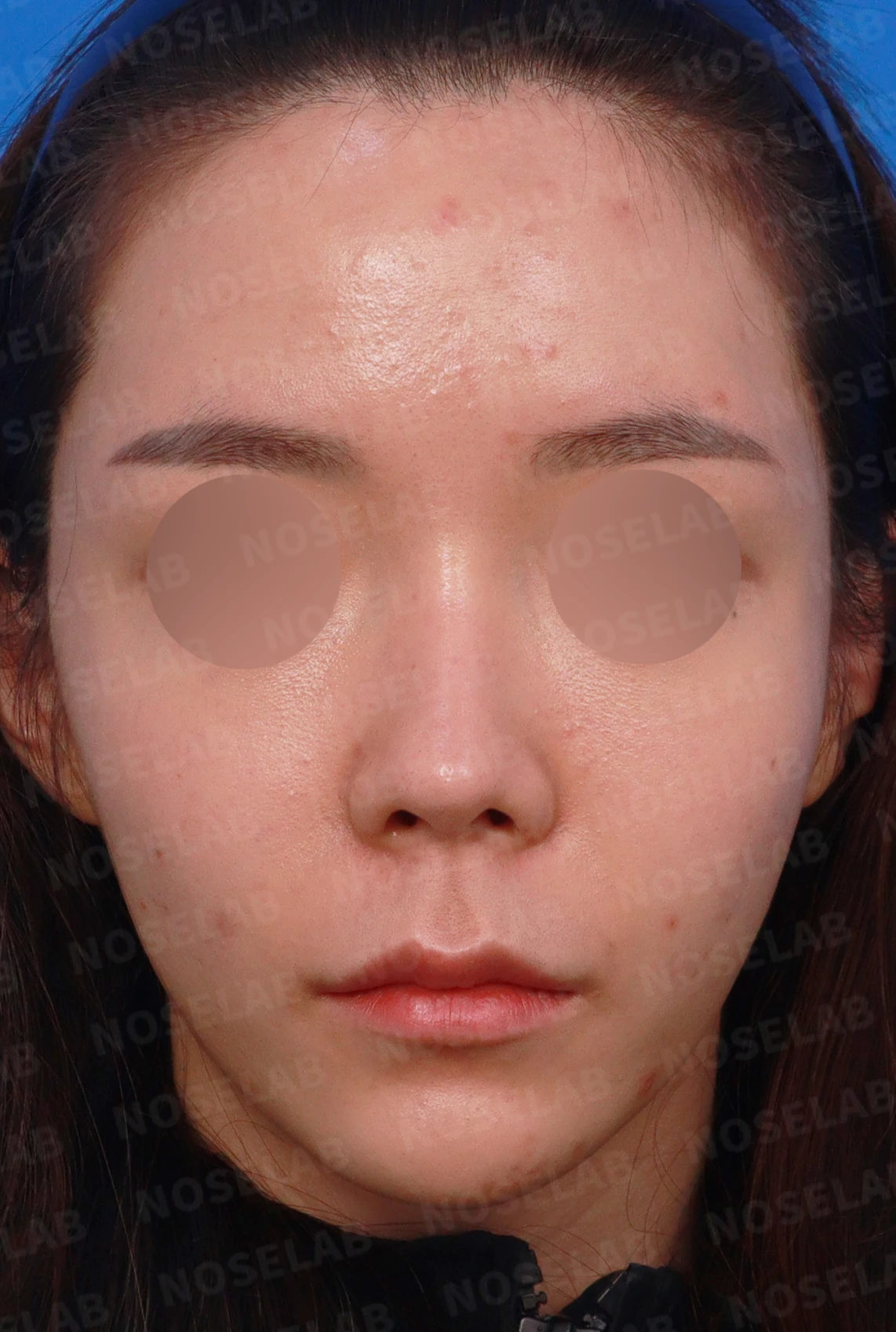 비주가 길어 보이는 이유와 코끝 연골 재배치 방법 — 디자인 상담 정면, 좌측 측면, 비스듬한 측면 사진입니다.