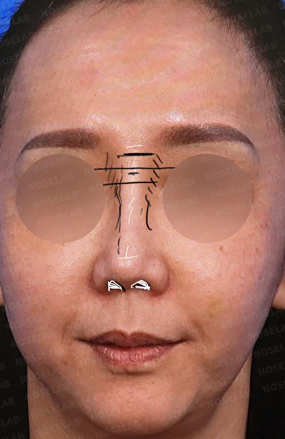 시작점 내리기로 긴코 교정 방법 — 본문 사진 1