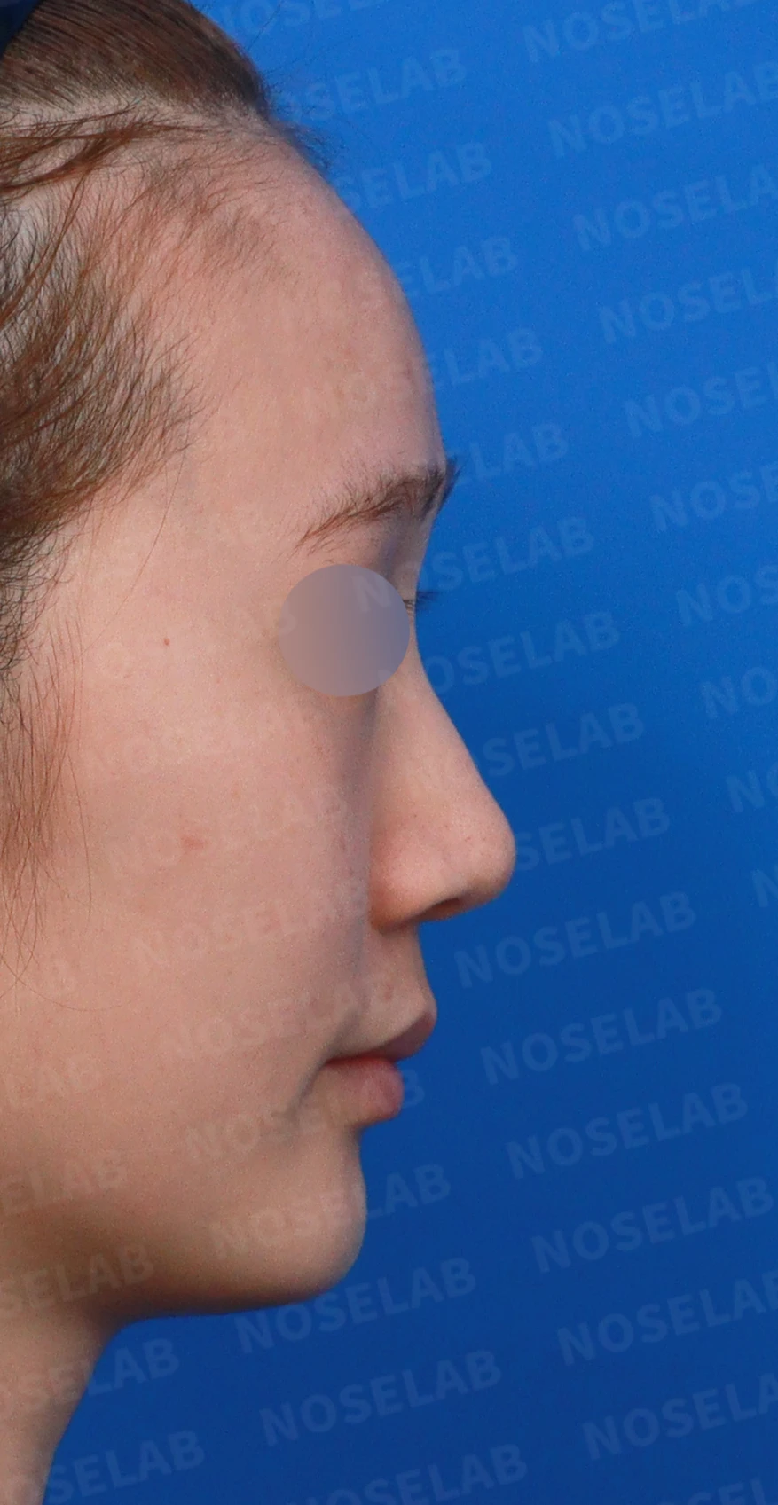 퍼진 코끝에 코막힘이 함께 오는 이유, 이물질 제거와 재건은 어떻게 하나 — 디자인 상담 우측 측면, 비스듬한 측면, 비공 사진입니다.