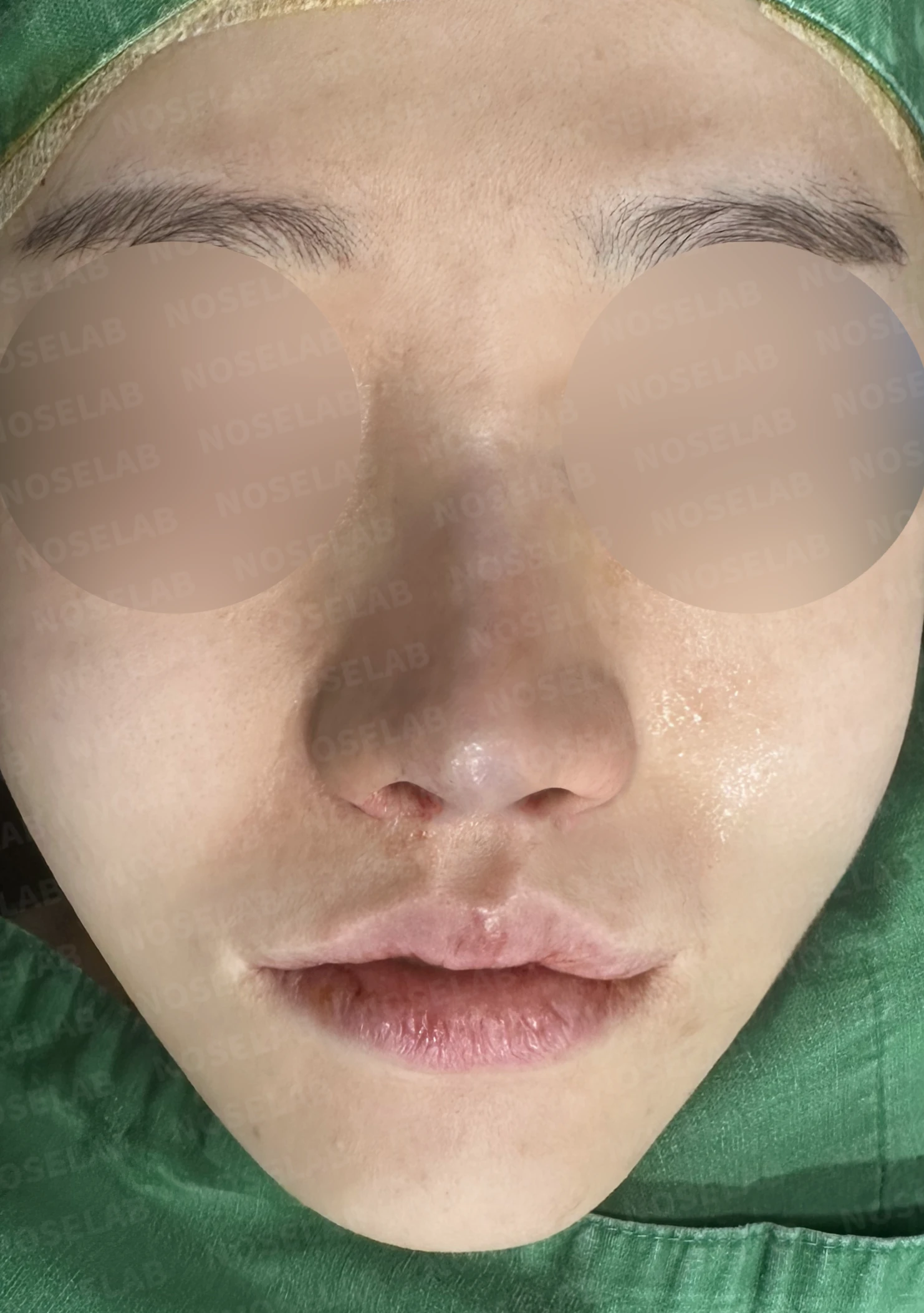 콧구멍 좌우가 심하게 달라 보이는 이유, 연골 재건과 피부이식 교정은 어떻게 하나 — 수술 직후 0일 정면, 비스듬한 측면, 측면 사진입니다. 직후 사진은 부기가 있는 상태로 최종 결과와 다를 수 있습니다.