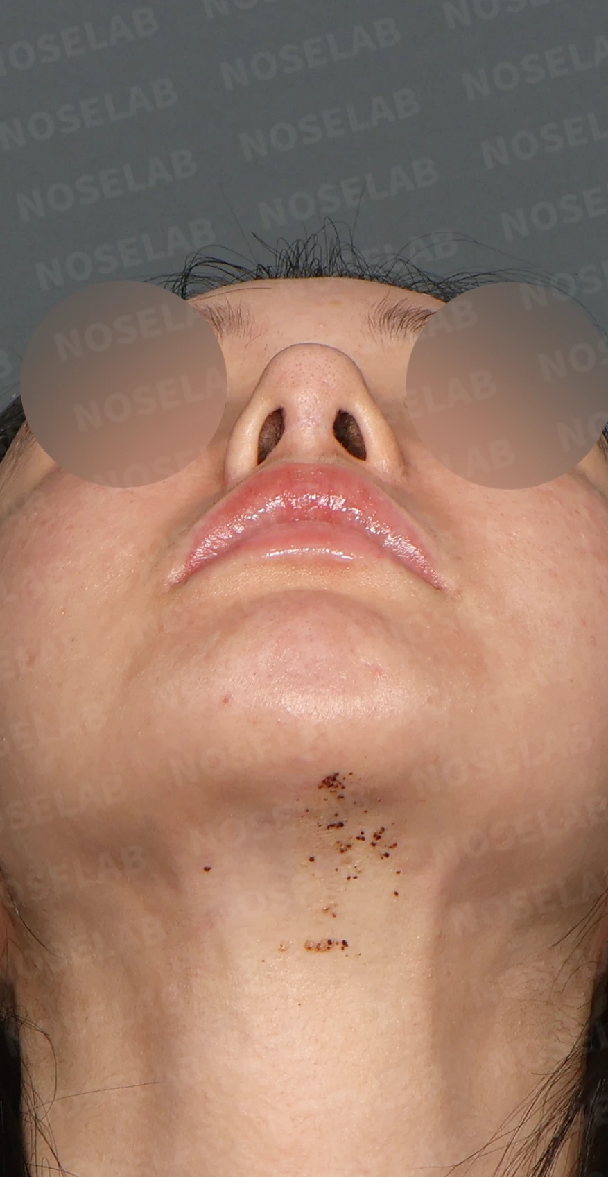 이물질 제거와 자가늑연골 비중격 재건, 들린 코 교정한 코재수술 — 디자인 상담 우측 측면, 비스듬한 측면, 비공 사진입니다.