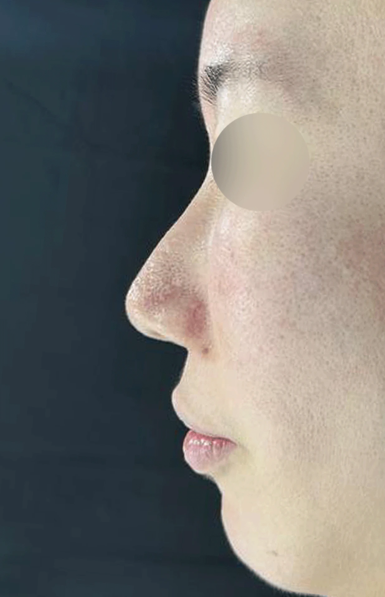 오래된 코 수술 뒤 비주가 함몰되고 코끝이 뭉툭해지는 이유와 재건 방법 — 본문 사진 9