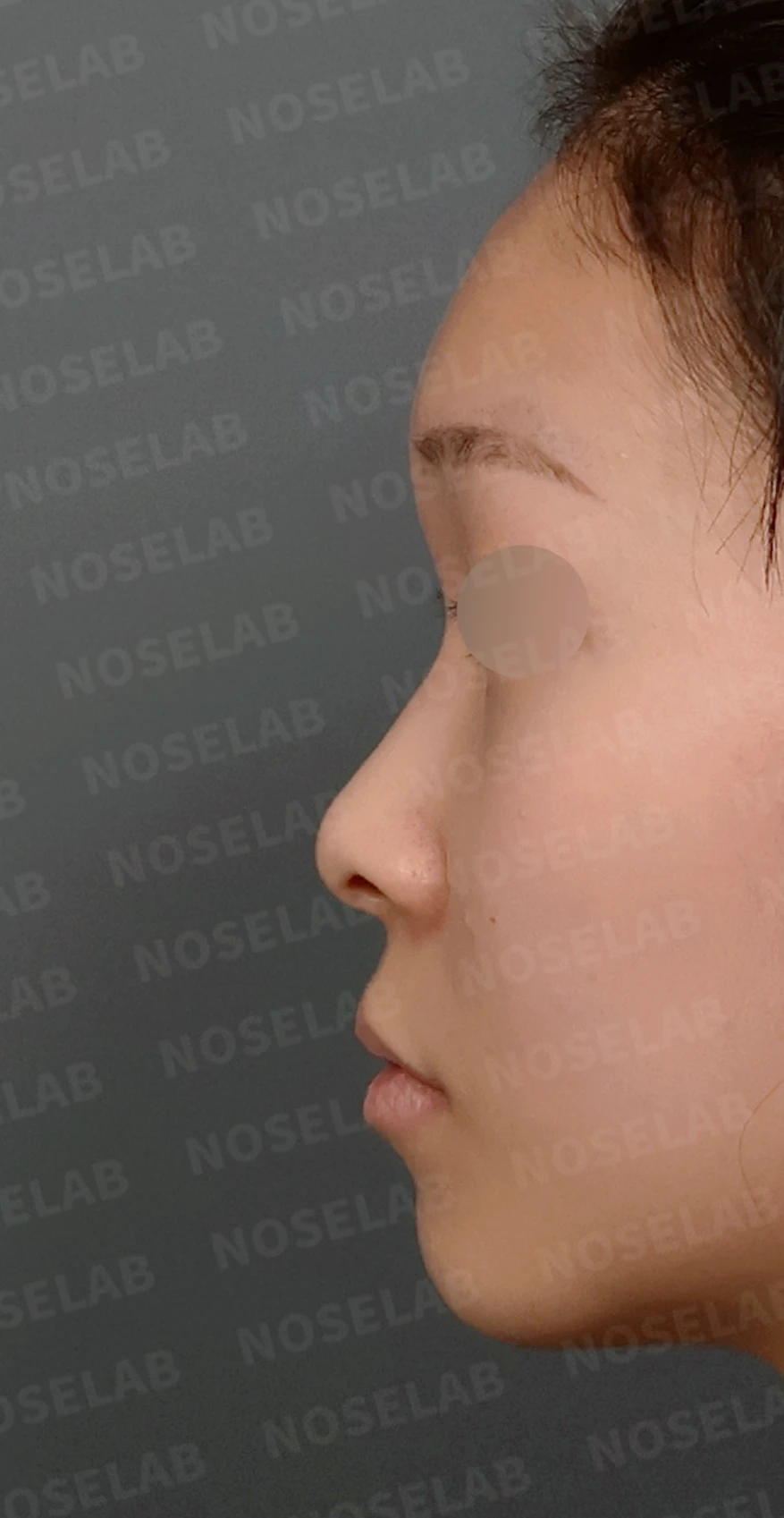 낮고 퍼진 코, 기증늑연골과 실리콘 보형물로 자연스러운 코 라인 완성 — 디자인 상담 정면, 좌측 측면, 비스듬한 측면 사진입니다.