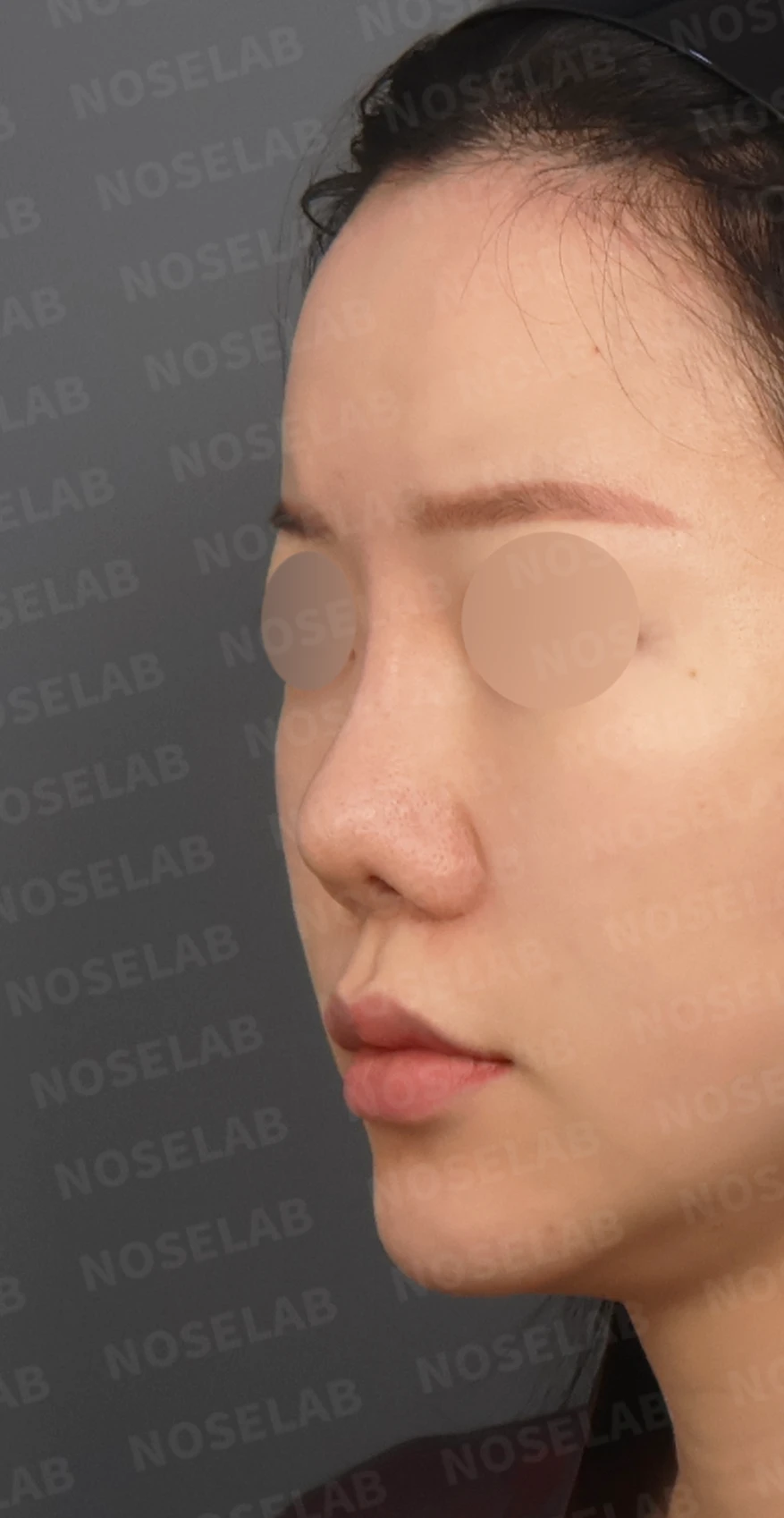 짧은 코와 복코, 자가늑연골로 세련되게 교정한 코재수술 — 디자인 상담 정면, 좌측 측면, 비스듬한 측면 사진입니다.