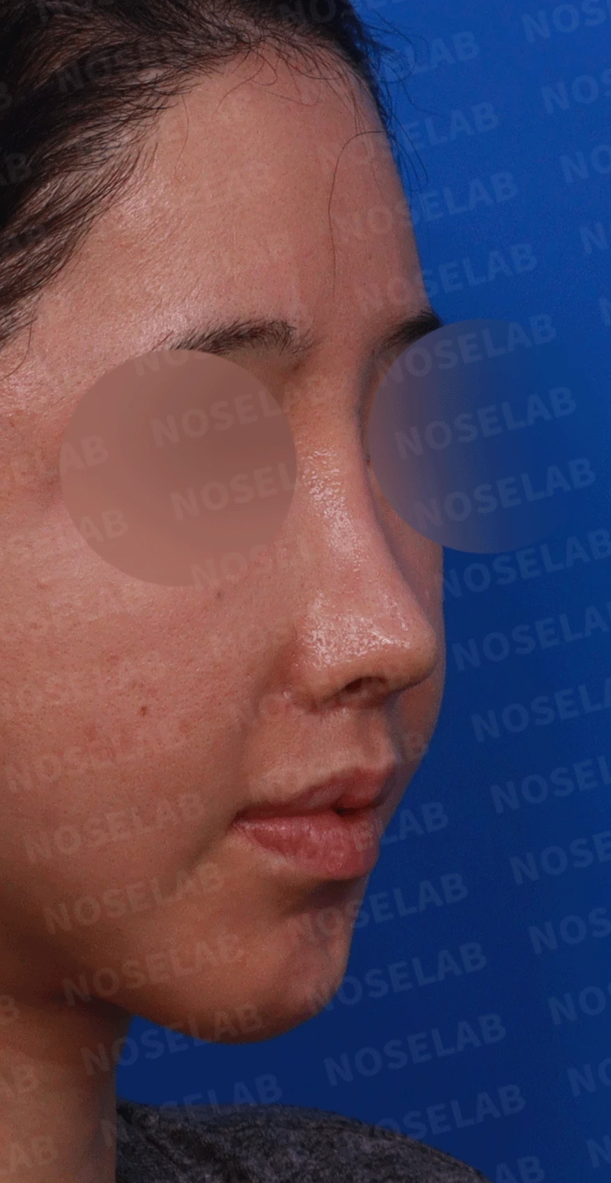 다수 재수술 후 인공진피 흡수와 비중격 손상 재건 사례 — 디자인 상담 우측 측면 , 비스듬한 측면, 비공 사진