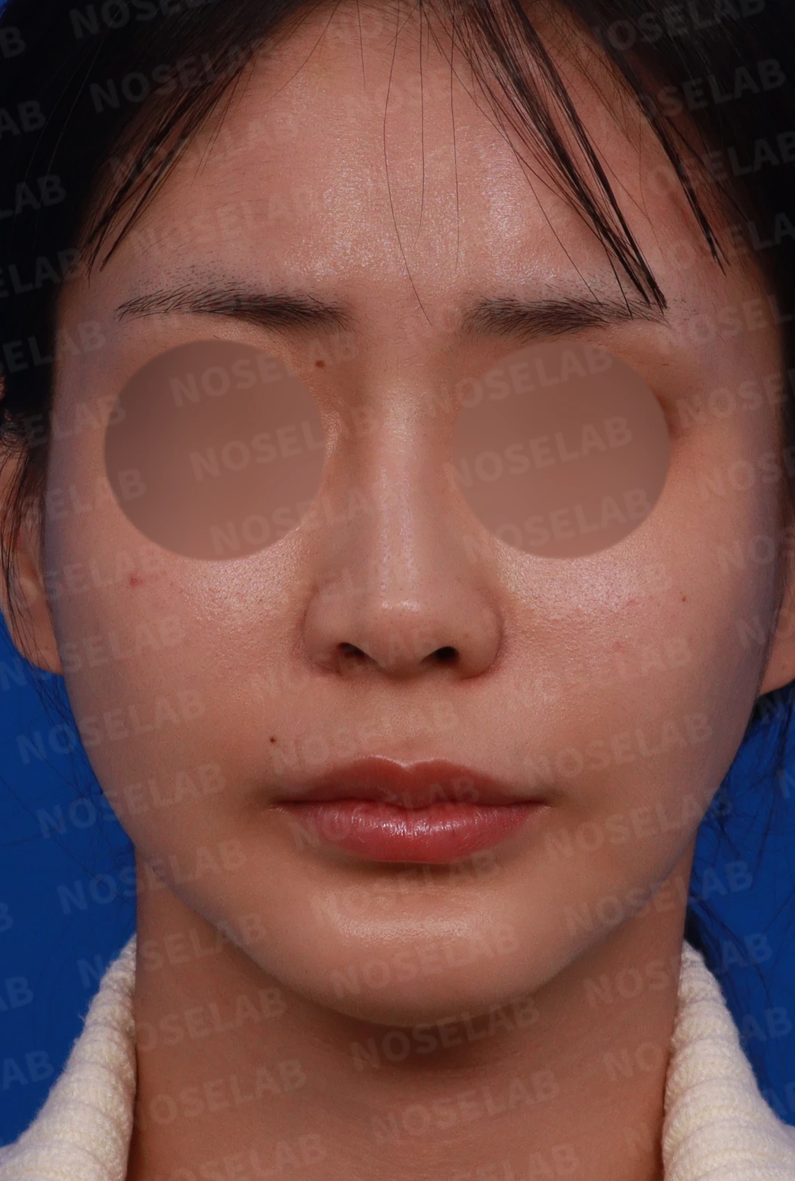 양악수술 뒤 비중격이 손상되고 비염이 재발하는 이유 — 디자인 상담 정면, 좌측 측면, 비스듬한 측면 사진