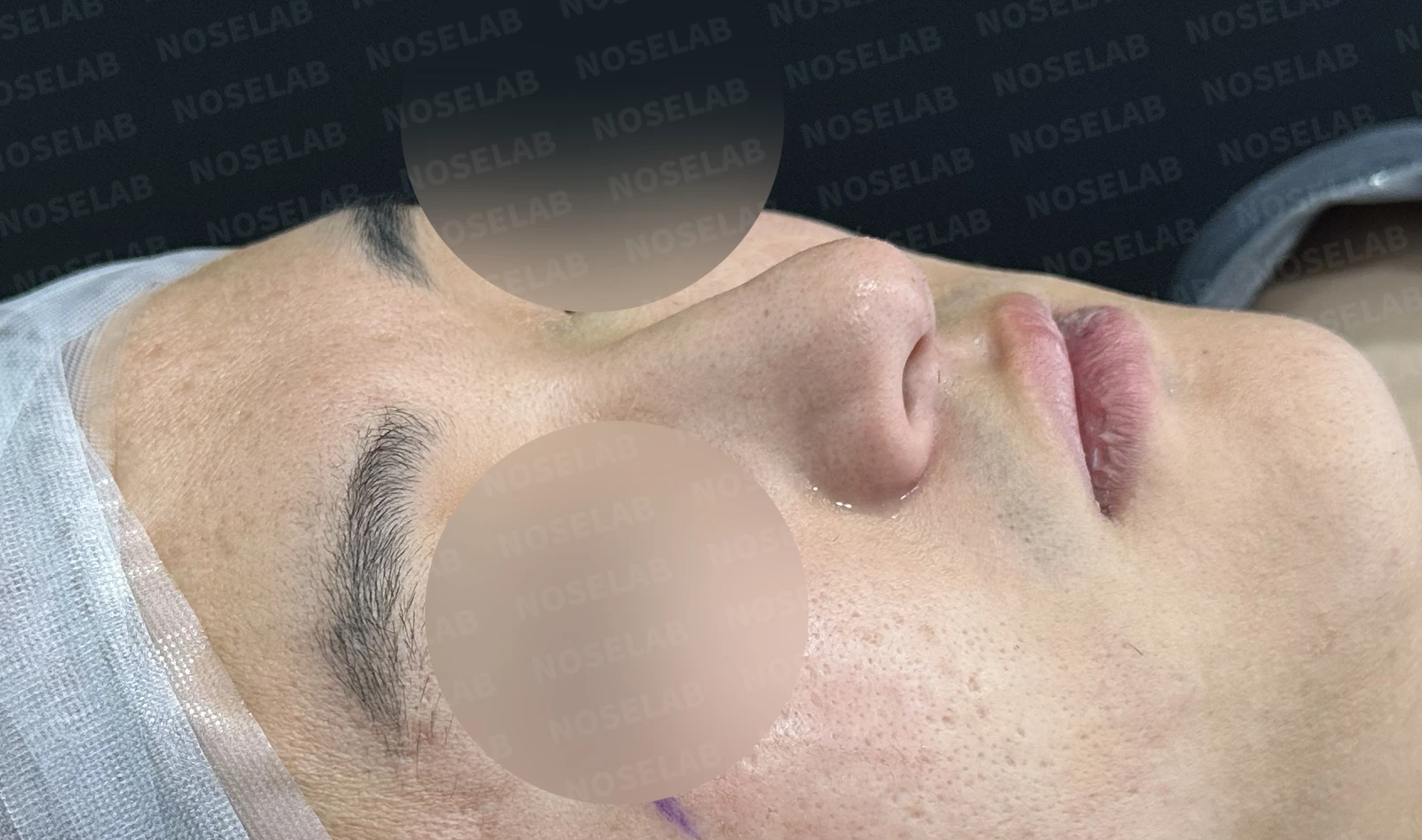 휜코 교정하면 안면 비대칭이 좋아질까요? — 수술 전 / 수술 직후 0일 직후 사진은 부기가 있는 상태로 최종 결과와 다를 수 있습니다.