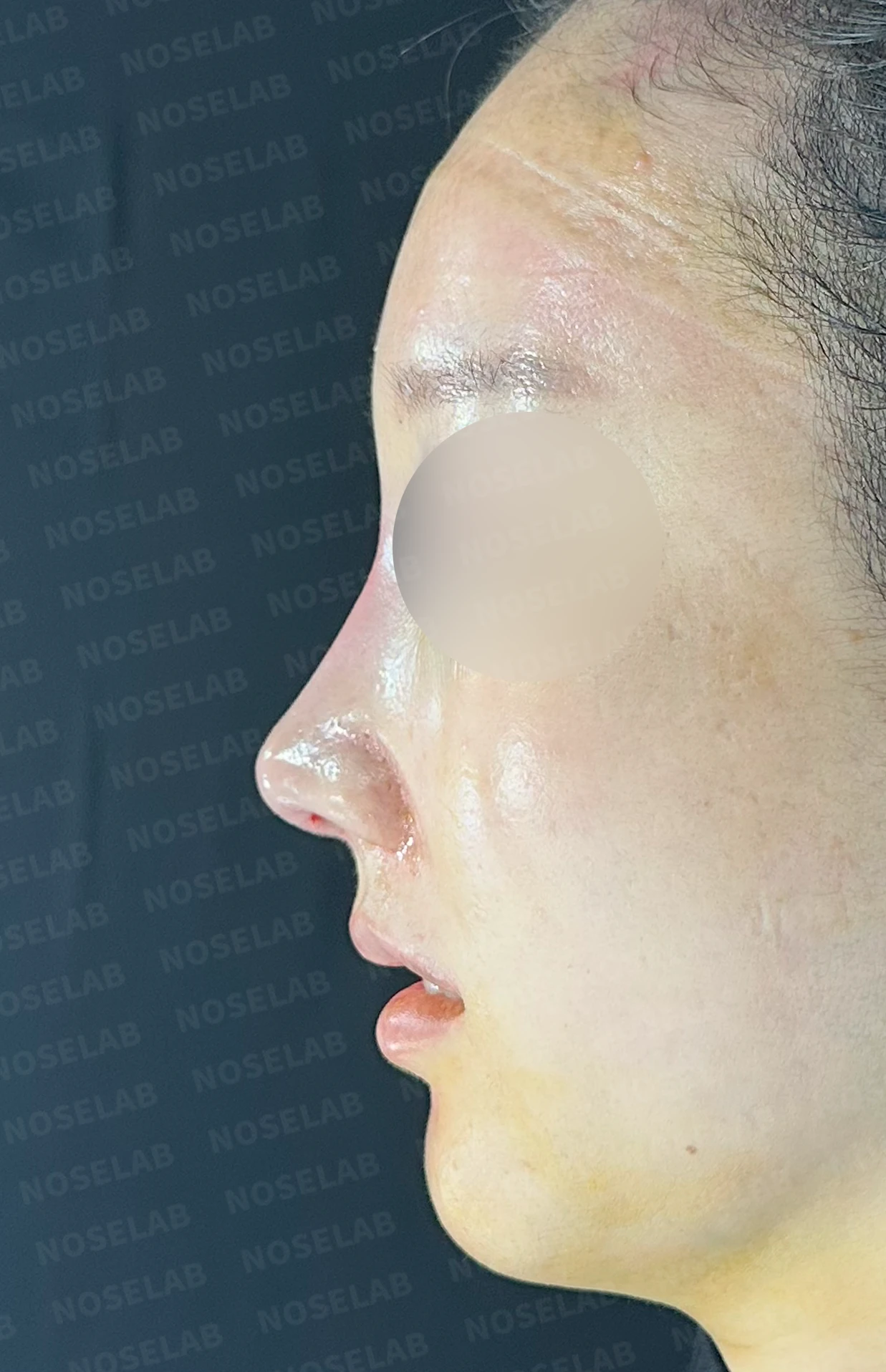 비공 비대칭과 코끝 처짐은 왜 생기나, 연골을 병용한 재건 방법 — 수술 직후 0일 정면, 측면, 비스듬한 측면 사진 직후 사진은 부기가 있는 상태로 최종 결과와 다를 수 있습니다.
