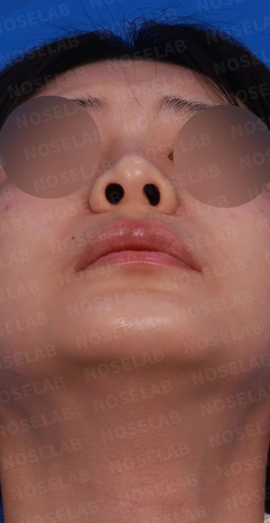 양악수술 뒤 비중격이 손상되고 비염이 재발하는 이유 — 디자인 상담 정면, 우측 측면, 비스듬한 측면 사진