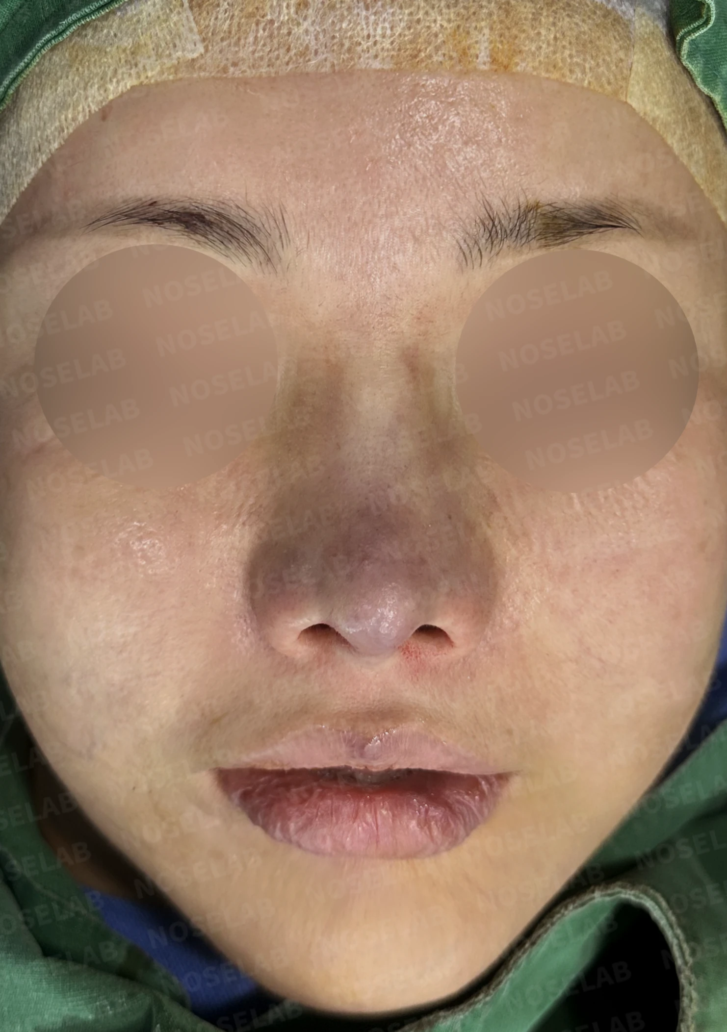 비중격 소실 후 들린 코끝과 찝혀 보이는 콧날개, 자가늑연골로 정밀 재건 — 수술직후 정면, 비스듬한 측면, 측면 사진입니다.