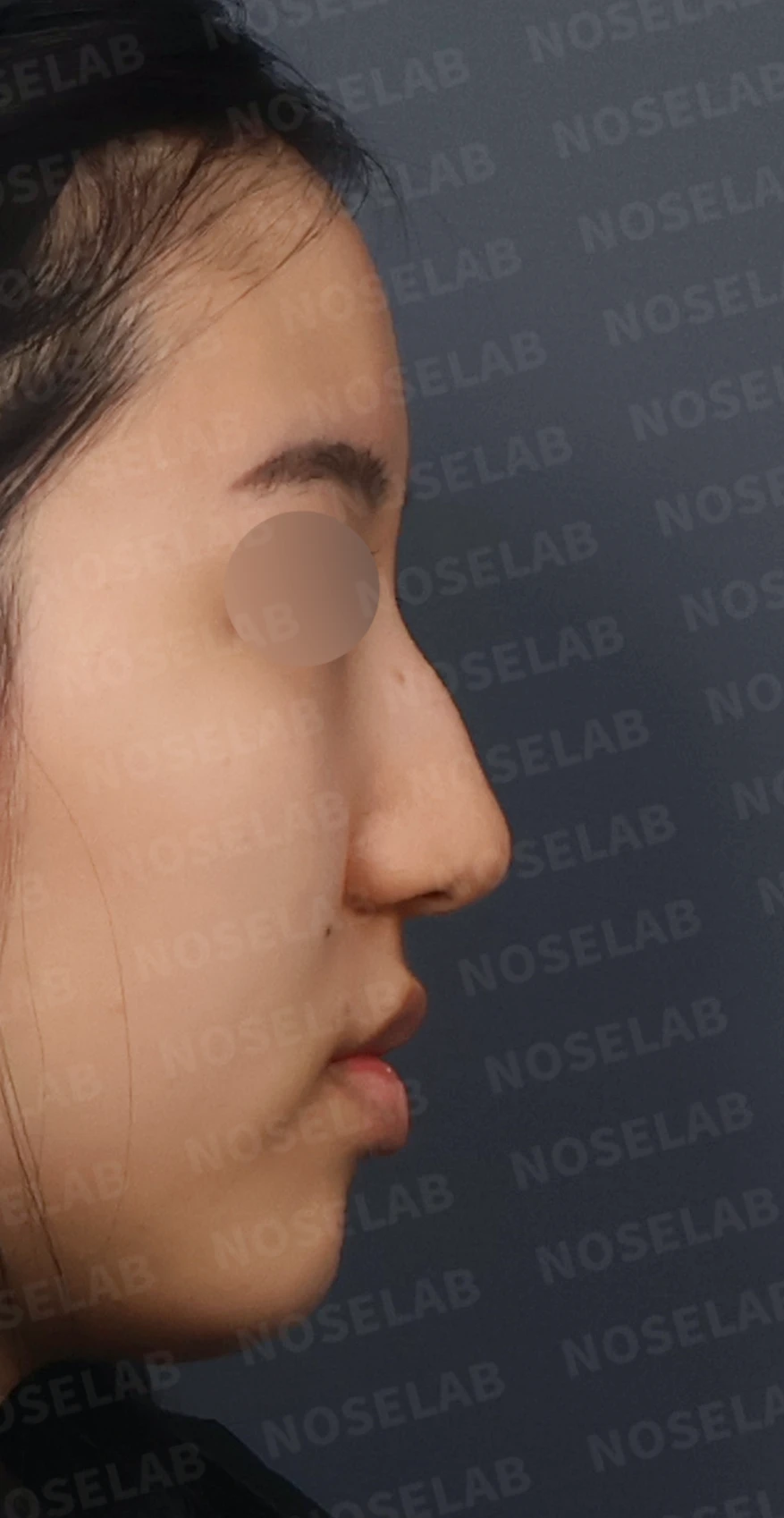 매부리코와 긴코 교정, 자가늑연골로 오똑한 코끝과 코막힘까지 해결 — 디자인 상담 우측 측면, 비스듬한 측면, 비공 사진입니다.