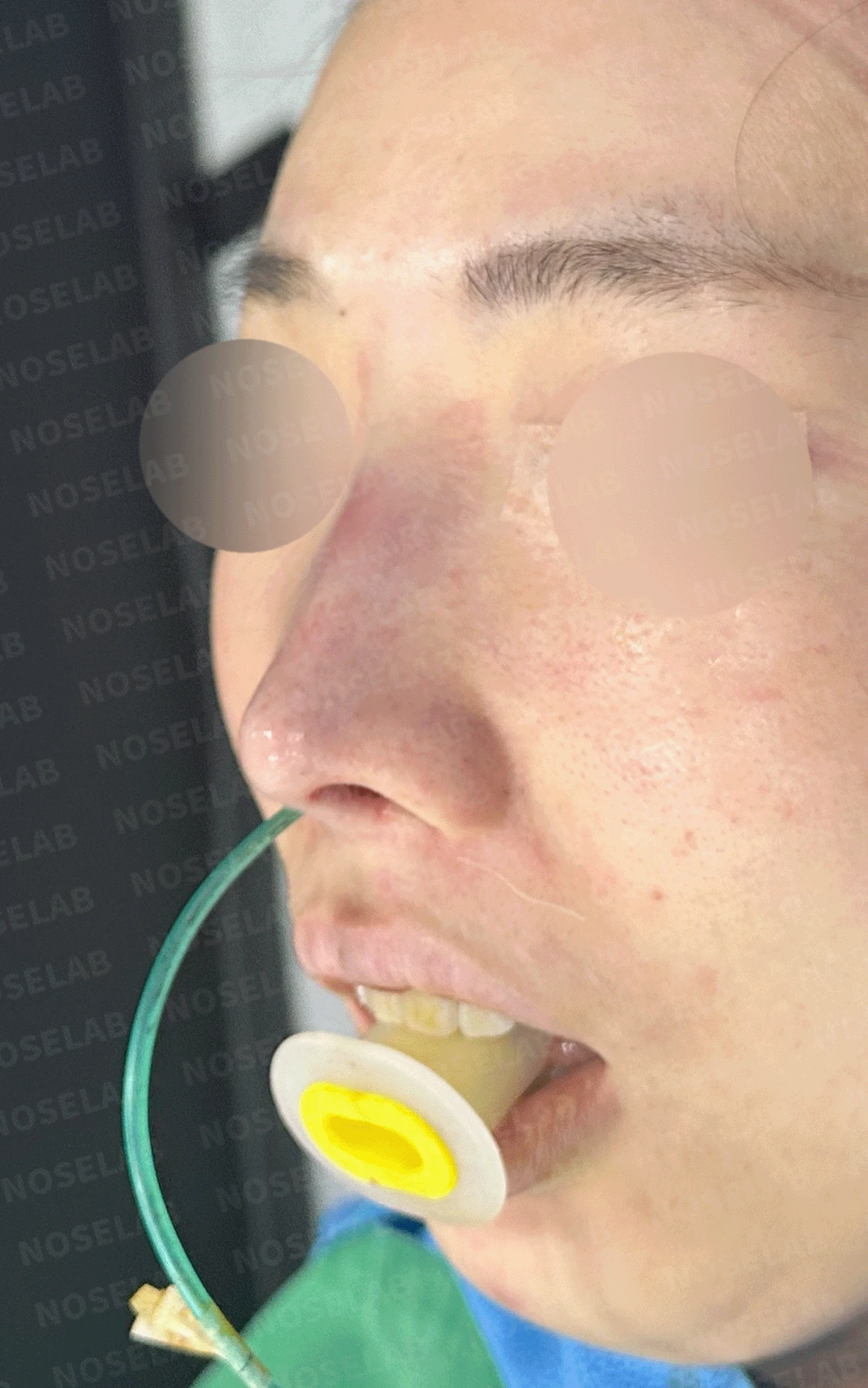 코성형 절골 후 콧등이 꺼지고 한쪽이 막히는 이유, 비밸브 재건과 복원 — 본문 사진 14