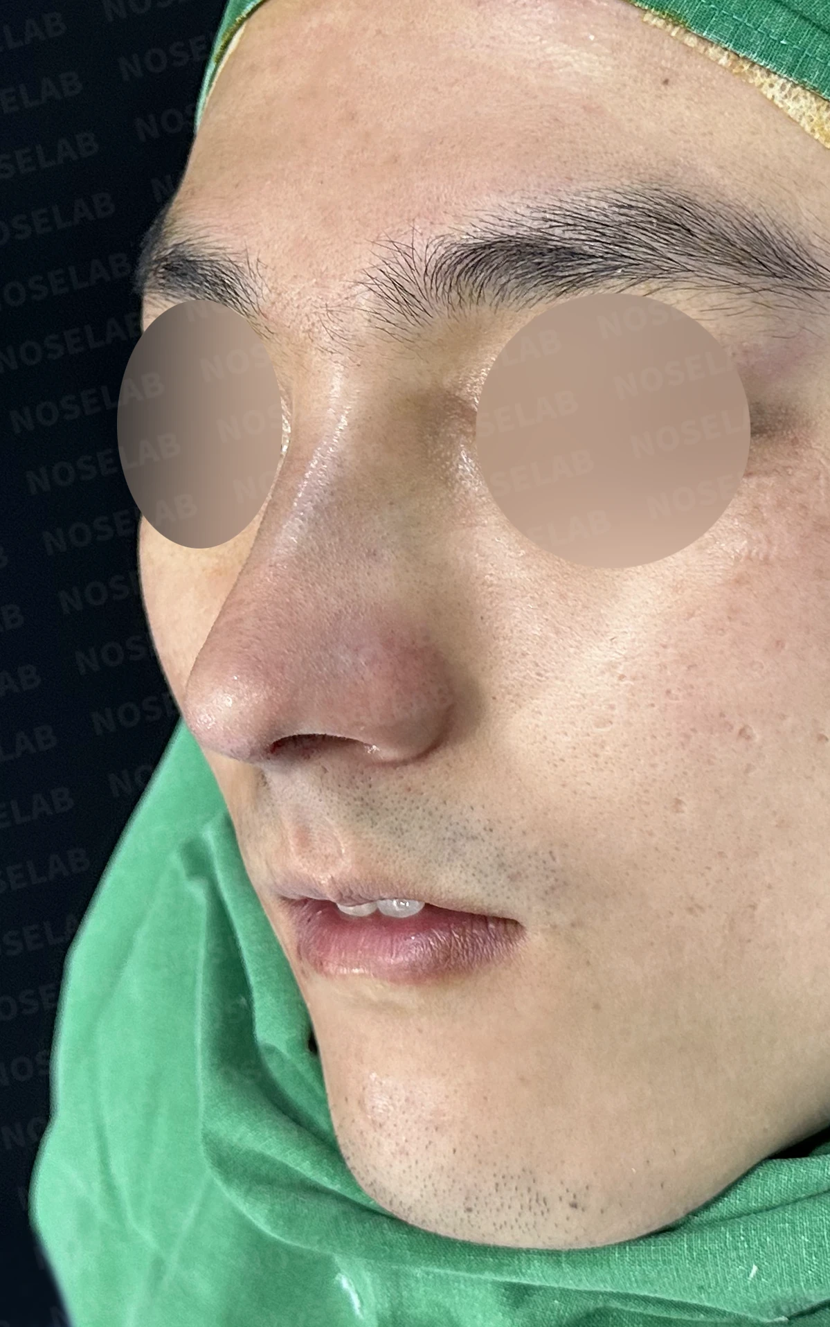 비중격이 휘면 코막힘과 휜 코가 함께 생기는 이유, 재건은 어떻게 하나 — 수술 직후 0일 정면, 비스듬한 측면, 측면 사진입니다. 직후 사진은 부기가 있는 상태로 최종 결과와 다를 수 있습니다.