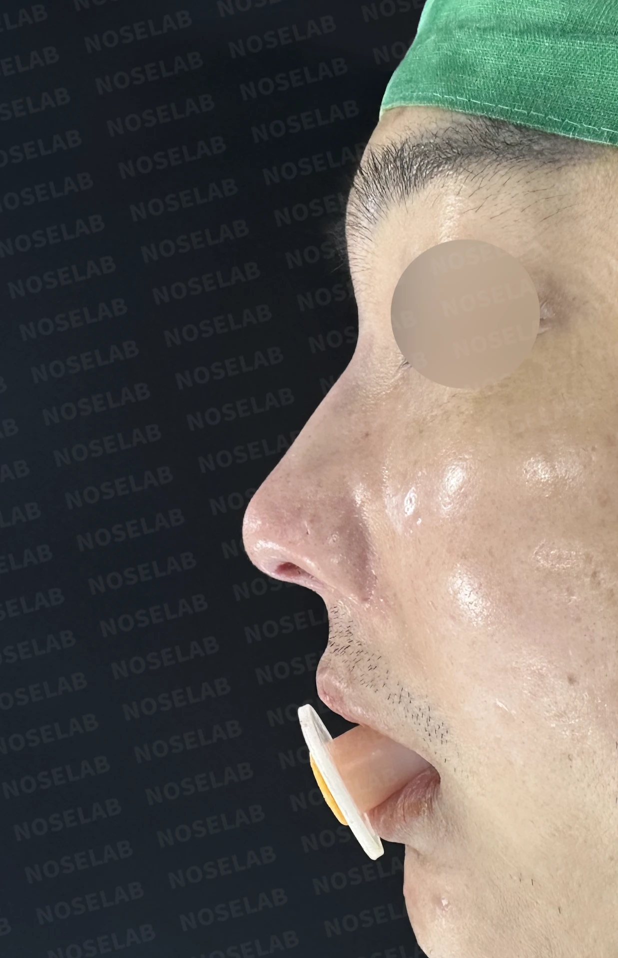 휜코 교정과 비공 비대칭, 자가늑연골로 바로잡은 코재수술 — 수술직후 정면, 비스듬한 측면, 측면 사진입니다.