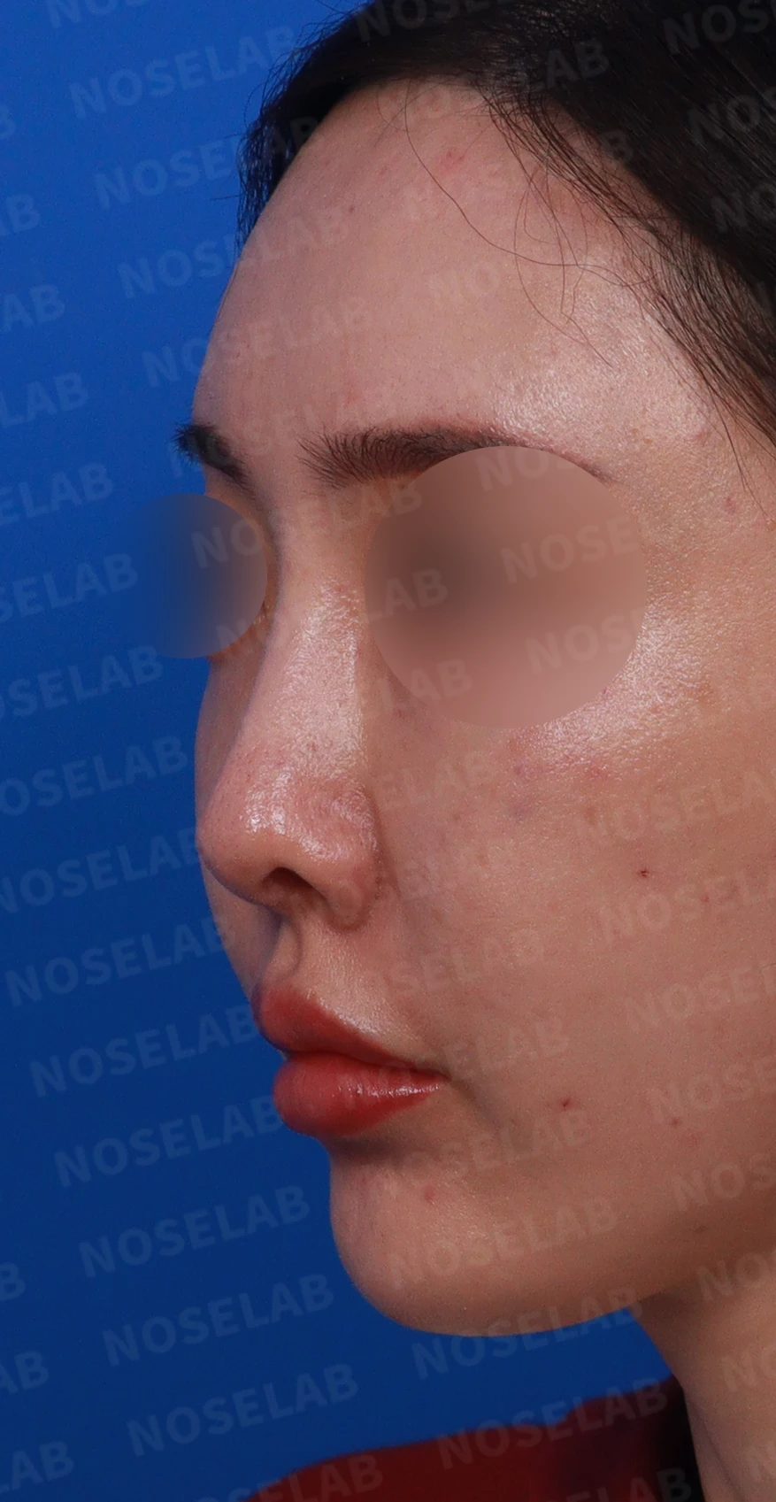 코성형 후 염증이 반복되는 이유와 자가 조직만으로 재건하는 방법 — 디자인 상담 정면 , 좌측 비스듬한 측면 , 측면 사진입니다.