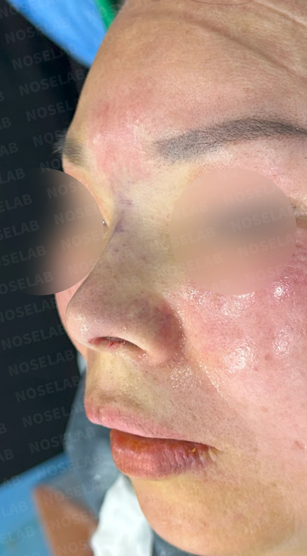 불법 주사 시술 뒤 코가 들리고 짧아지는 이유, 이물질 제거와 재건은 어떻게 하나 — 수술 직후 0일 정면, 측면, 비스듬한 측면 사진 직후 사진은 부기가 있는 상태로 최종 결과와 다를 수 있습니다.