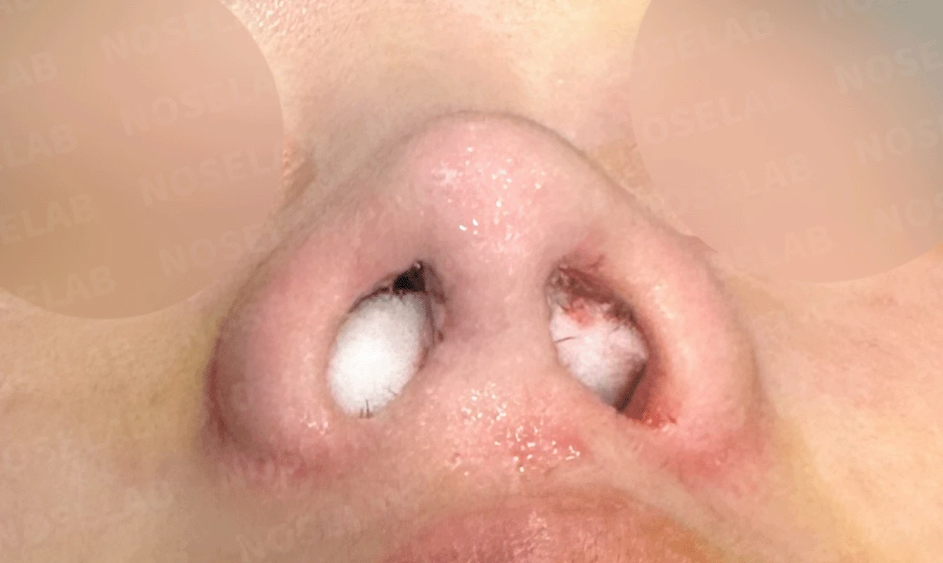 콧대가 인위적으로 보이고 코가 들리는 이유, 재건은 어떻게 하나 — 수술 직후 0일 비공 사진 직후 사진은 부기가 있는 상태로 최종 결과와 다를 수 있습니다.