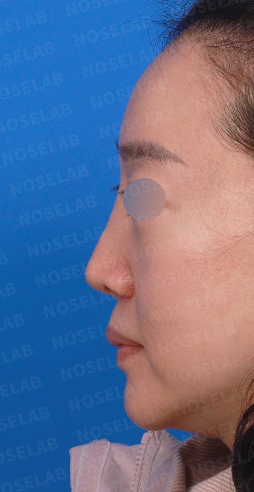 비중격이 한쪽으로 무너지면 코가 휘고 숨이 막히는 이유, 자가늑연골 재건 방법 — 디자인 상담 정면, 좌측 측면, 비스듬한 측면 사진입니다.