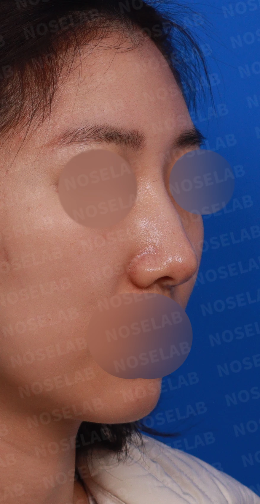매부리를 정리한 뒤 콧등이 눌려 보이고 코끝이 뭉툭해지는 이유, 보형물 없이 교정하는 방법 — 디자인 상담 우측 측면, 비스듬한 측면, 비공 사진